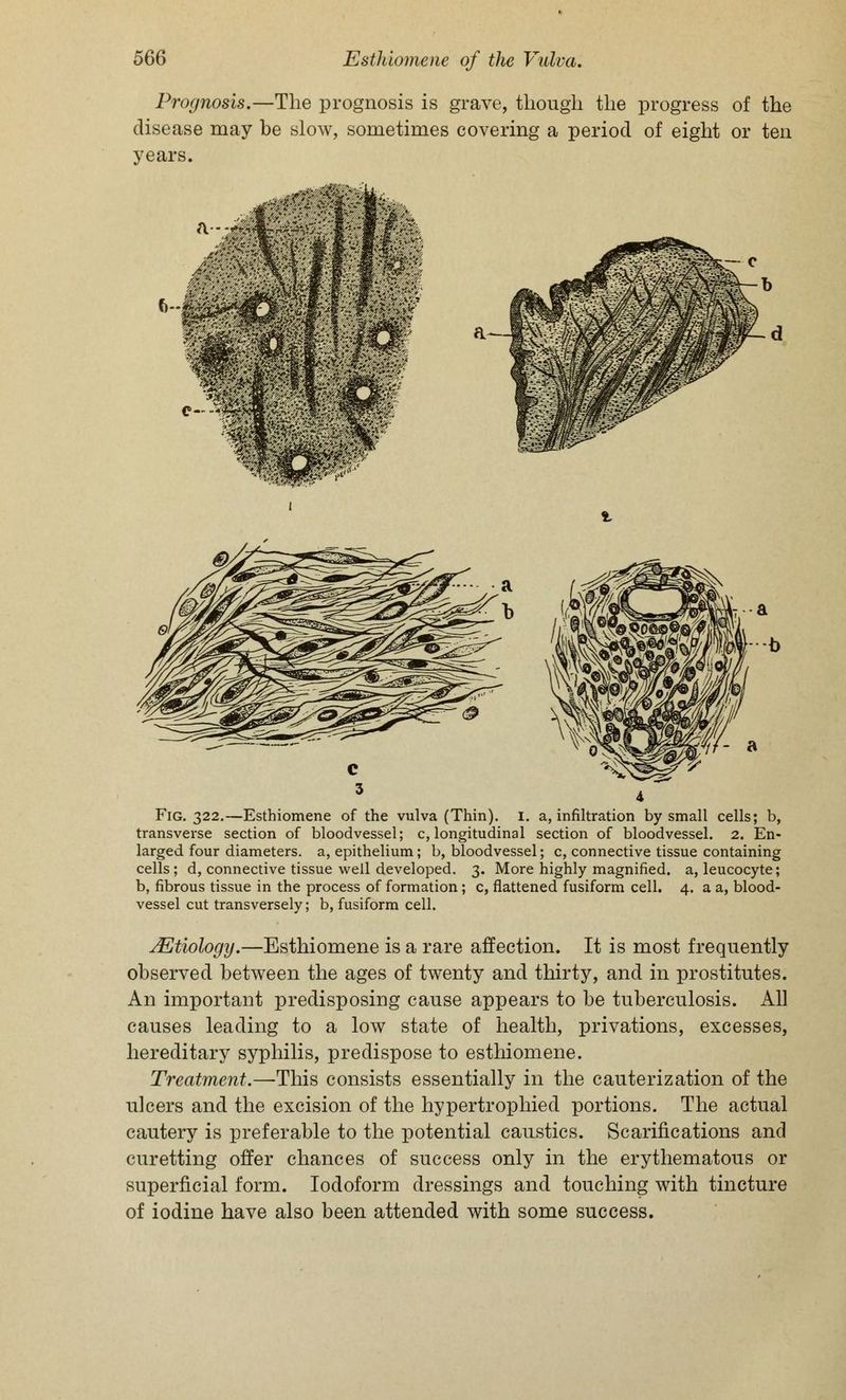 Prognosis.—The prognosis is grave, though the progress of the disease may be slow, sometimes covering a period of eight or ten years. Fig. 322.—Esthiomene of the vulva (Thin). 1. a, infiltration by small cells; b, transverse section of bloodvessel; c, longitudinal section of bloodvessel. 2. En- larged four diameters, a, epithelium; b, bloodvessel; c, connective tissue containing cells; d, connective tissue well developed. 3. More highly magnified, a, leucocyte; b, fibrous tissue in the process of formation; c, flattened fusiform cell. 4. a a, blood- vessel cut transversely; b, fusiform cell. ^Etiology.—Esthiomene is a rare affection. It is most frequently observed between the ages of twenty and thirty, and in prostitutes. An important predisposing cause appears to be tuberculosis. All causes leading to a low state of health, privations, excesses, hereditary syphilis, predispose to esthiomene. Treatment.—This consists essentially in the cauterization of the ulcers and the excision of the hypertrophied portions. The actual cautery is preferable to the potential caustics. Scarifications and curetting offer chances of success only in the erythematous or superficial form. Iodoform dressings and touching with tincture of iodine have also been attended with some success.