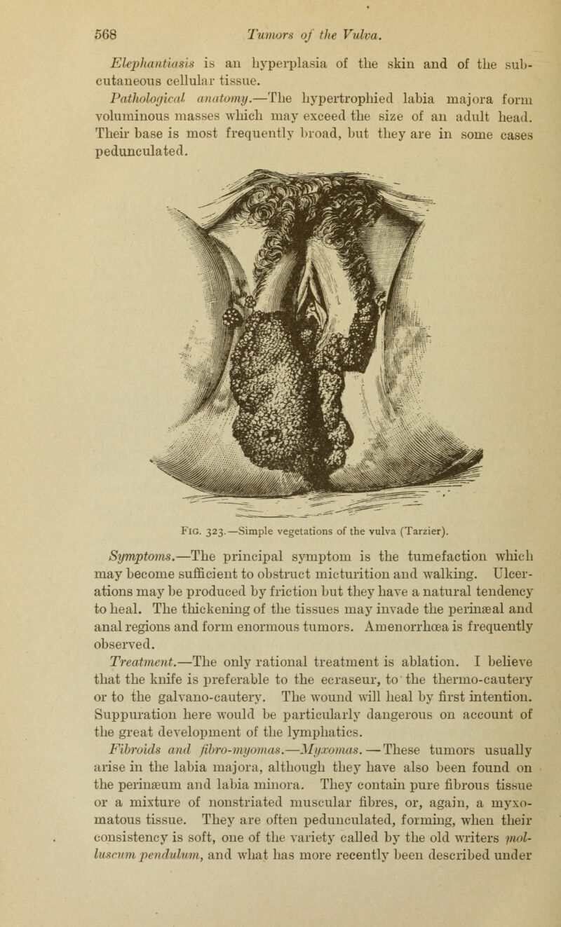 Elephantiasis is an hyperplasia of the skin and of the sub- cutaneous cellular tissue. Pathological anatomy.—The hypertrophied labia niajora form voluminous masses which may exceed the size of an adult head. Their base is most frequently broad, but they are in some cases pedunculated. Fig. 323.—Simple vegetations of the vulva (Tarzier). Symptoms.—The principal symptom is the tumefaction which may become sufficient to obstruct micturition and walking. Ulcer- ations may be produced by friction but they have a natural tendency to heal. The thickening of the tissues may invade the perinaeal and anal regions and form enormous tumors. Amenorrhcea is frequently observed. Treatment.—The only rational treatment is ablation. I believe that the knife is preferable to the ecraseur, to the thermo-cautery or to the galvano-cautery. The wound will heal by first intention. Suppuration here would be particularly dangerous on account of the great development of the lymphatics. Fibroids and fibro-myomas.—Myxomas.—These tumors usually arise in the labia major a, although they have also been found on the perinaeum and labia minora. They contain pure fibrous tissue or a mixture of nonstriated muscular fibres, or, again, a myxo- matous tissue. They are often pedunculated, forming, when their consistency is soft, one of the variety called by the old writers piol- lu8cvm pendulum, and what has more recently been described under