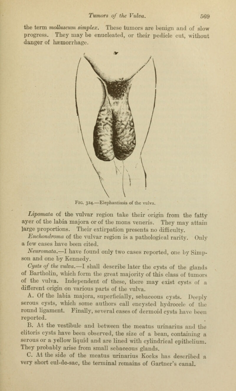the term molluscum simplex. These tumors are benign and of slow- progress. They may be enucleated, or their pedicle cut, without danger of haemorrhage. Fig. 324.—Elephantiasis of the vulva. Lipomata of the vulvar region take their origin from the fatty ayer of the labia majora or of the mons veneris. They may attain large proportions. Their extirpation presents no difficulty. Enchondroma of the vulvar region is a pathological rarity. Only a few cases have been cited. Xrtiromata.—I have found only two cases reported, one by Simp- son and one by Kennedy. Cysts of the vulva.—I shall describe later the cysts of the glands of Bartholin, which form the great majority of this class of tumors of the vulva. Independent of these, there may exist cyst> of a different origin on various parts of the vulva. A. Of the labia majora, superficially, Bebaceoua cysts. Deeply serous cysts, wmich some authors call encysted hydrocele of the round ligament. Finally, several cases of dermoid cysts haw been reported. B. At the vestibule and between the meatus urinarius and the clitoris cysts have been observed, the size of a bean, contain; serous or a yellow liquid and are lined with cylindrical epithelium. They probably arise from small sebaceous glands. C. At the side of the meatus urinarius Kocks has describe very short cul-de-sac, the terminal remains of Gartner's canal.