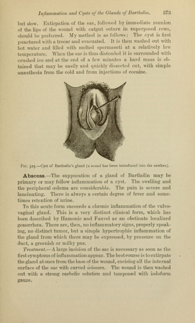 but slow. Extirpation of the sac, followed by immediate reunion of the lips of the wound with catgut suture in superposed rowB, should be preferred. My method is as follows: The cyst is firsl punctured with a trocar and evacuated. It i> then washed out with hot water and filled with melted spermaceti at a relatively low temperature. When the sac is thus distended it is surrounded with crushed ice and at the end of a few minutes a hard mass is ob- tained that may be easily and quickly dissected out, with simple anaesthesia from the cold and from injections of cocaine. Fig. 325.—Cyst of Bartholin's gland (a sound has been introduced into the urethra). Abscess.—The suppuration of a gland of Bartholin may be primary or may follow inflammation of a cyst. The swelling and the peripheral cedema are considerable. The pain is severe and lancinating. There is always a certain degree of fever and some- times retention of urine. To this acute form succeeds a chronic inflammation of the vulvo- vaginal gland. This is a very distinct clinical form, which has been described by Hamonic and Fauvel as an obstinate localized gonorrhoea. There are, then, no inflammatory Bigns, properly speak- ing, no distinct tumor, but a simple hypertrophic inflammation of the gland from which there may be expressed, by pressure 011 the duct, a greenish or milky pus. Treatment.—A large incision of the sac is necessary as soon as the first symptoms of inflammation appear. The best course i- to extirpate the gland at once from the base of the wound, excising all the internal surface of the sac with curved scissors. The wound is then washed out with a strong carbolic solution and tamponed with iodoform gauze.