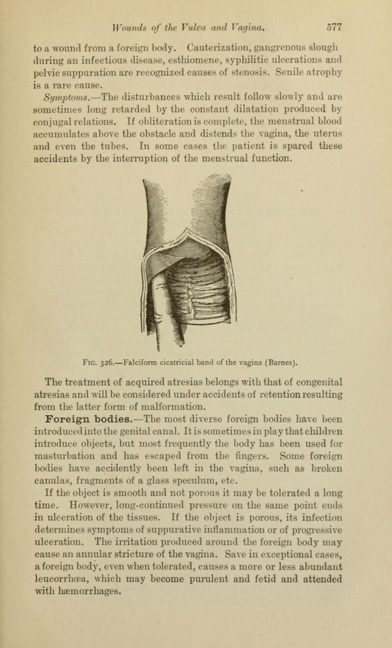 to a wound from a foreign body. Cauterization, gangrenous slough during an infectious disease, esthiomene, syphilitic ulcerations and pelvic suppuration are recognized causes of stenosis. Senile atrophy is a rare cause. Symptoms.—The disturbances which result follow slowly and are sometimes long retarded by the constant dilatation produced by conjugal relations. If obliteration is complete, the menstrual blood accumulates above the obstacle and distends the vagina, the uterus and even the tubes. In some cases the patient is spared these accidents by the interruption of the menstrual function. Fig. 326.—Falciform cicatricial band of the vagina (Barnes). The treatment of acquired atresias belongs with that of congenital atresias and will be considered under accidents of retention resulting from the latter form of malformation. Foreign bodies.—The most diverse foreign bodies have been introduced into the genital canal. It is sometimes in play that children introduce objects, but most frequently the body has been used for masturbation and has escaped from the ringers. Some foreign bodies have accidently been left in the vagina, such as broken canulas, fragments of a glass speculum, etc. If the object is smooth and not porous it may be tolerated a long time. However, long-continued pressure on the same point ends in ulceration of the tissues. If the object is porous, its infection determines symptoms of suppurative inflammation or of progressive ulceration. The irritation produced around the foreign body may cause an annular stricture of the vagina. Save in exceptional cases, aforeignbody, even when tolerated, causes a more or less abundant leucorrhcea, which may become purulent and fetid and attended with haemorrhages.