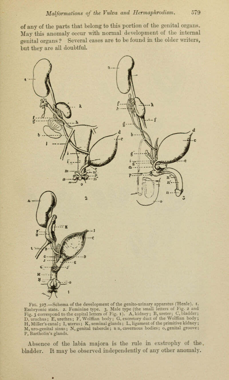 of any of the parts that belong to this portion of the genital organs. May this anomaly occur with normal development of the internal genital organs ? Several cases are to be found in the older writers, but they are all doubtful. Fig. 327.—Schema of the development of the genito-urinary apparatus (Henle1!. I. Embryonic state. 2. Feminine type. 3. Male type (the small letters of Fig. 2 and Fig. 3 correspond to the capital letters of Fig. 1). A, kidney; B, ureter; C, bladder D,urachns; E, urethra; F, Wolffian body; G, excretory duct of the Wolffian body H, Miller's canal; I, uterus; K, seminal glands ; L, ligament of the primitive kidney M, uro-genital sinus; N, genital tubercle; n n, cavernous bodies; o,genital groove P, Bartholin's glands. Absence of the labia majora is the rule in exstrophy of the bladder. It may be observed independently of any other anomaly.