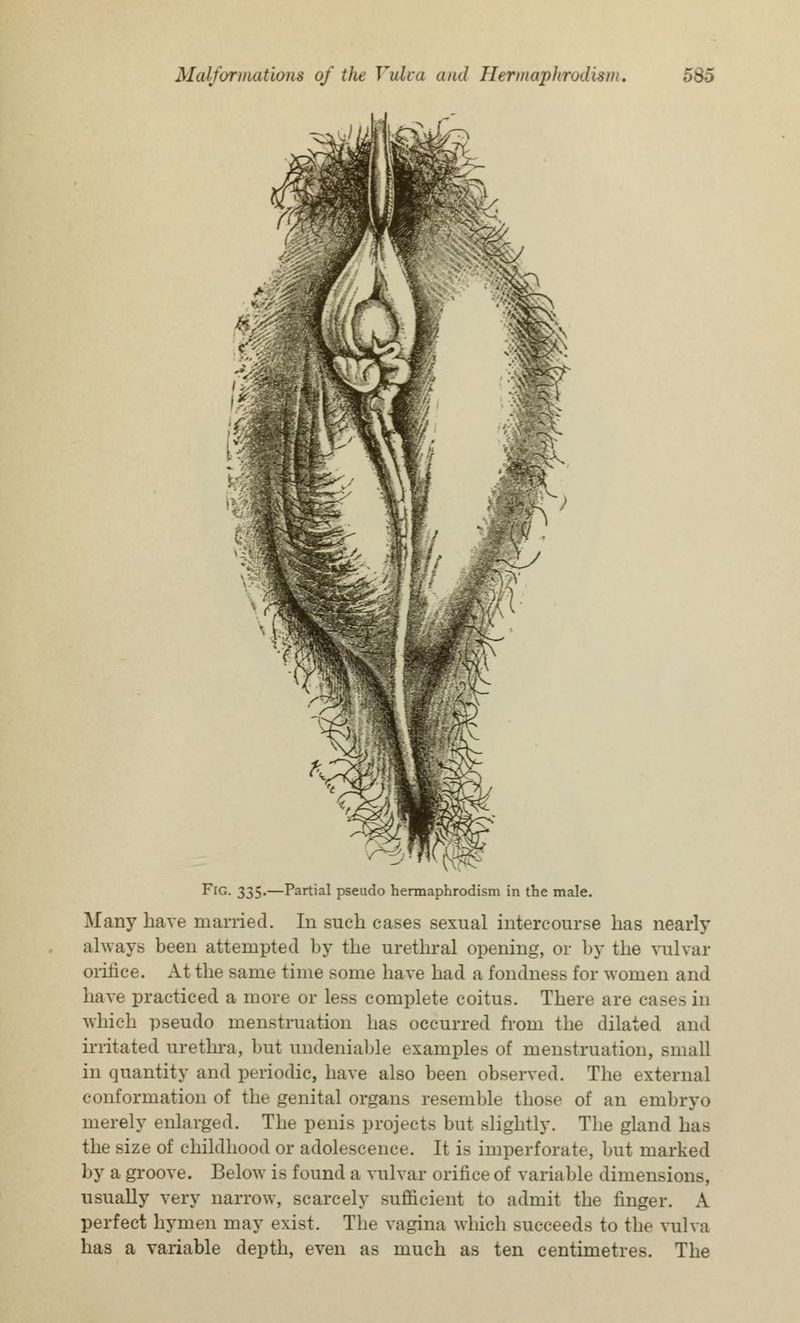 Fig. 335.—Partial pseudo hermaphrodism in the male. Many have married. In such cases sexual intercourse has nearly always been attempted by the urethral opening, or by the vulvar orifice. At the same time some have had a fondness for women and have practiced a more or less complete coitus. There are cast- in which pseudo menstruation has occurred from the dilated and irritated urethra, but undeniable examples of menstruation, small in quantity and periodic, have also been observed. The external conformation of the genital organs resemble those of an embryo merely enlarged. The penis projects but slightly. The gland has the size of childhood or adolescence. It is imperforate, but marked by a groove. Below is found a vulvar orifice of variable dimensions, usually very narrow, scarcely sufficient to admit the finger. A perfect hymen may exist. The vagina which succeeds to the vulva has a variable depth, even as much as ten centimetres. The