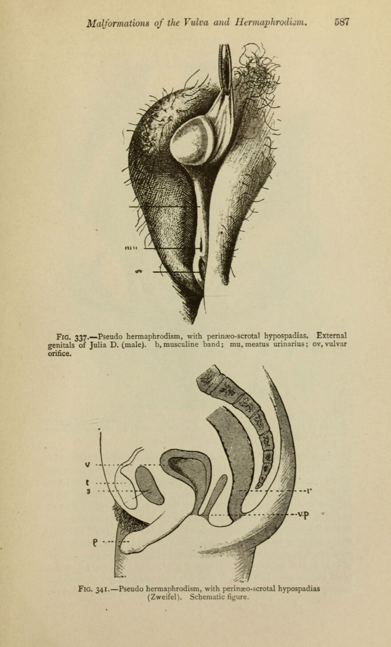 Fig. 337.—Pseudo hermaphrodism, with perinaeo-scrotal hypospadias. External genitals of Julia D. (male), b, musculine band; mu, meatus urinarius; ov, vulvar orifice. Fig. 341.—Pseudo hermaphrodism, with perinaeo-scrotal hypospadias (Zweifel). Schematic figure.