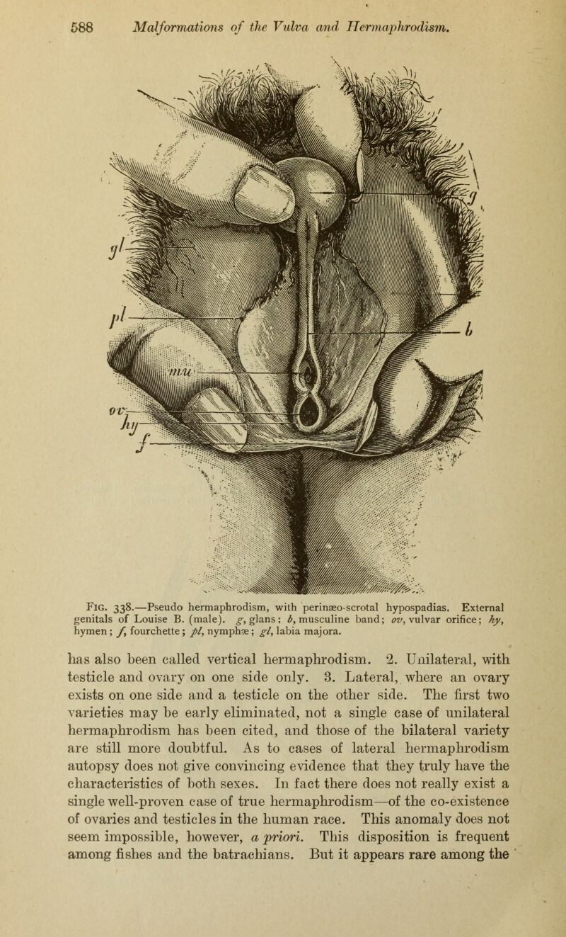 Fig. 338.—Pseudo hermaphrodism, with perineoscrotal hypospadias. External genitals of Louise B. (male), g, glans; b, musculine band; ov, vulvar orifice; hy, hymen ; f, fourchette; pi, nymph*; gl, labia majora. has also been called vertical hermaphrodism. 2. Unilateral, with testicle and ovary on one side only. 3. Lateral, where an ovary exists on one side and a testicle on the other side. The first two varieties may be early eliminated, not a single case of unilateral hermaphrodism has been cited, and those of the bilateral variety are still more doubtful. As to cases of lateral hermaphrodism autopsy does not give convincing evidence that they truly have the characteristics of both sexes. In fact there does not really exist a single well-proven case of true hermaphrodism—of the co-existence of ovaries and testicles in the human race. This anomaly does not seem impossible, however, a priori. This disposition is frequent among fishes and the batrachians. But it appears rare among the