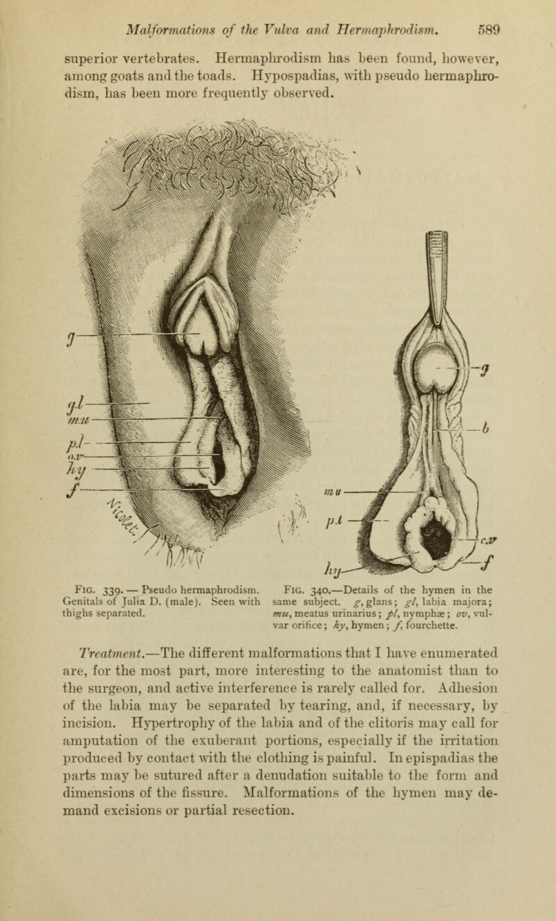 superior vertebrates. Hermaphrodism lias been found, however, among goats and the toads. Hypospadias, with pseudo hermaphro- dism, has been more frequently observed. Fig. 339. — Pseudo hermaphrodism. Genitals of Julia D. (male). Seen with thighs separated. Fig. 340.—Details of the hymen in the same subject, g, glans; gl, labia majora; mu, meatus urinarius ; pi, nymphae ; ov, vul- var orifice; hy, hymen ; f, fourchette. Treatment.—The different malformations that I have enumerated are, for the most part, more interesting to the anatomist than to the surgeon, and active interference is rarely called for. Adhesion of the labia may be separated by tearing, and, if necessary, by incision. Hypertrophy of the labia and of the clitoris may call for amputation of the exuberant portions, especially if the irritation produced by contact with the clothing is painful. In epispadias the parts may be sutured after a denudation suitable to the form and dimensions of the fissure. Malformations of the hymen may de- mand excisions or partial resection.