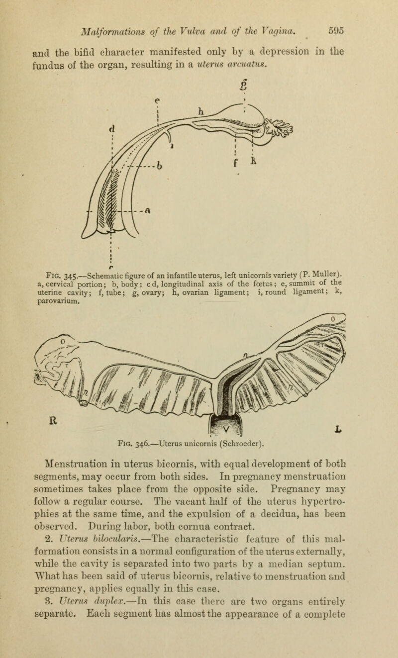 and the bifid character manifested only by a depression in the fundus of the organ, resulting in a uterus arcuatus. & Fig. 345.—Schematic figure of an infantile uterus, left unicornis variety (P. Muller). a, cervical portion; b, body; c d, longitudinal axis of the foetus; e, summit of the uterine cavity; f, tube; g, ovary; h, ovarian ligament; i, round ligament; k, parovarium. Fig. 346.—Uterus unicornis (Schroeder). Menstruation in uterus bicornis, with equal development of both segments, may occur from both sides. In pregnancy menstruation sometimes takes place from the opposite side. Pregnancy may follow a regular course. The vacant half of the uterus hypertro- phies at the same time, and the expulsion of a decidua, has been observed. During labor, both cornua contract. 2. Uterus bUoadaris.—The characteristic feature of tins mal- formation consists in a normal configuration of the uterus externally, while the cavity is separated into two parts by a median septum. What has been said of uterus bicornis, relative to menstruation and pregnancy, applies equally in this en- 3. Uterus duplex.—In this case there are two organs entirely separate. Each segment has almost the appearance of a complete