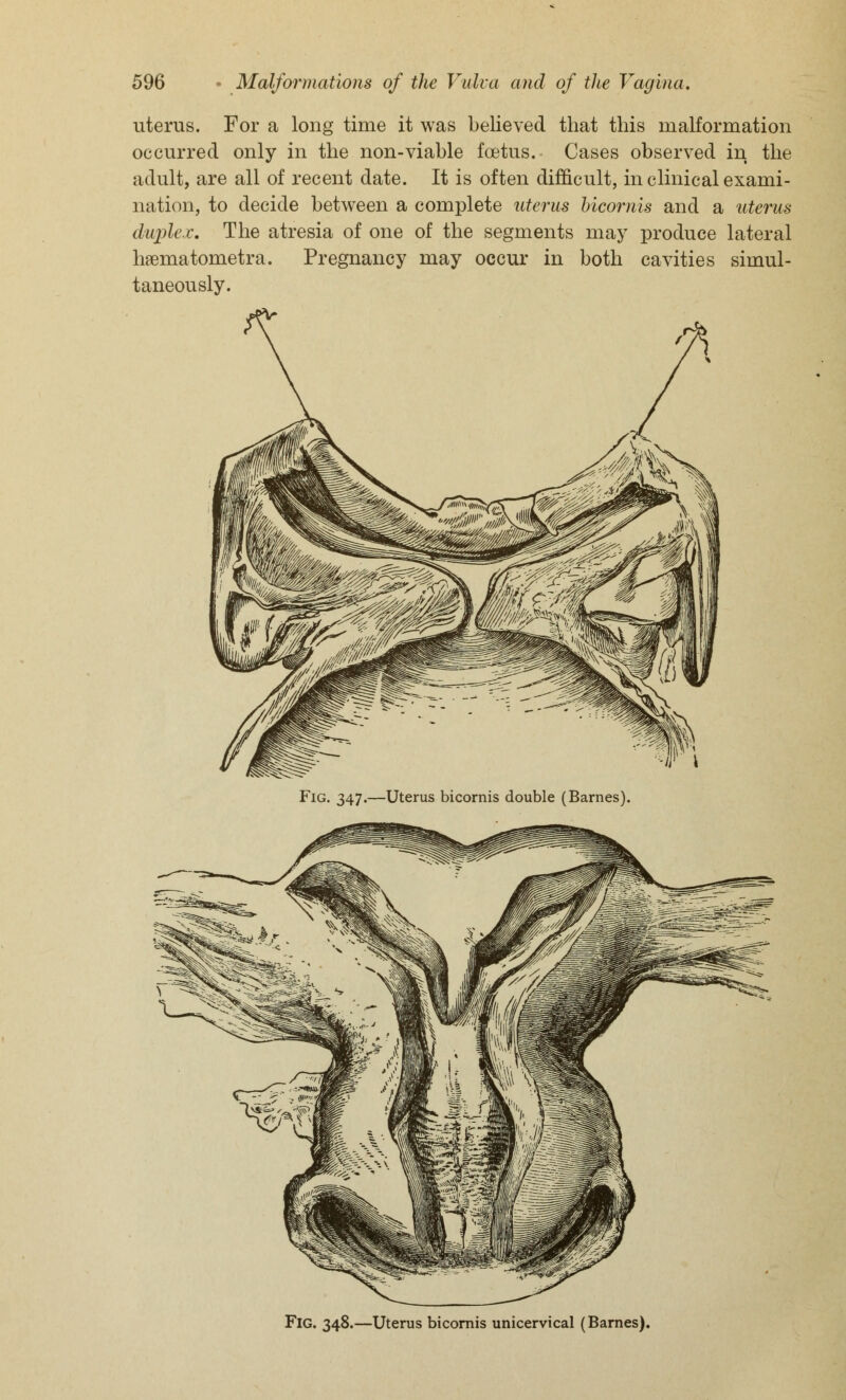 uterus. For a long time it was believed that this malformation occurred only in the non-viable foetus. Cases observed in the adult, are all of recent date. It is often difficult, in clinical exami- nation, to decide between a complete uterus bicornis and a uterus duplex. The atresia of one of the segments may produce lateral hsematometra. Pregnancy may occur in both cavities simul- taneously. Fig. 347.—Uterus bicornis double (Barnes). Fig. 348.—Uterus bicornis unicervical (Barnes).