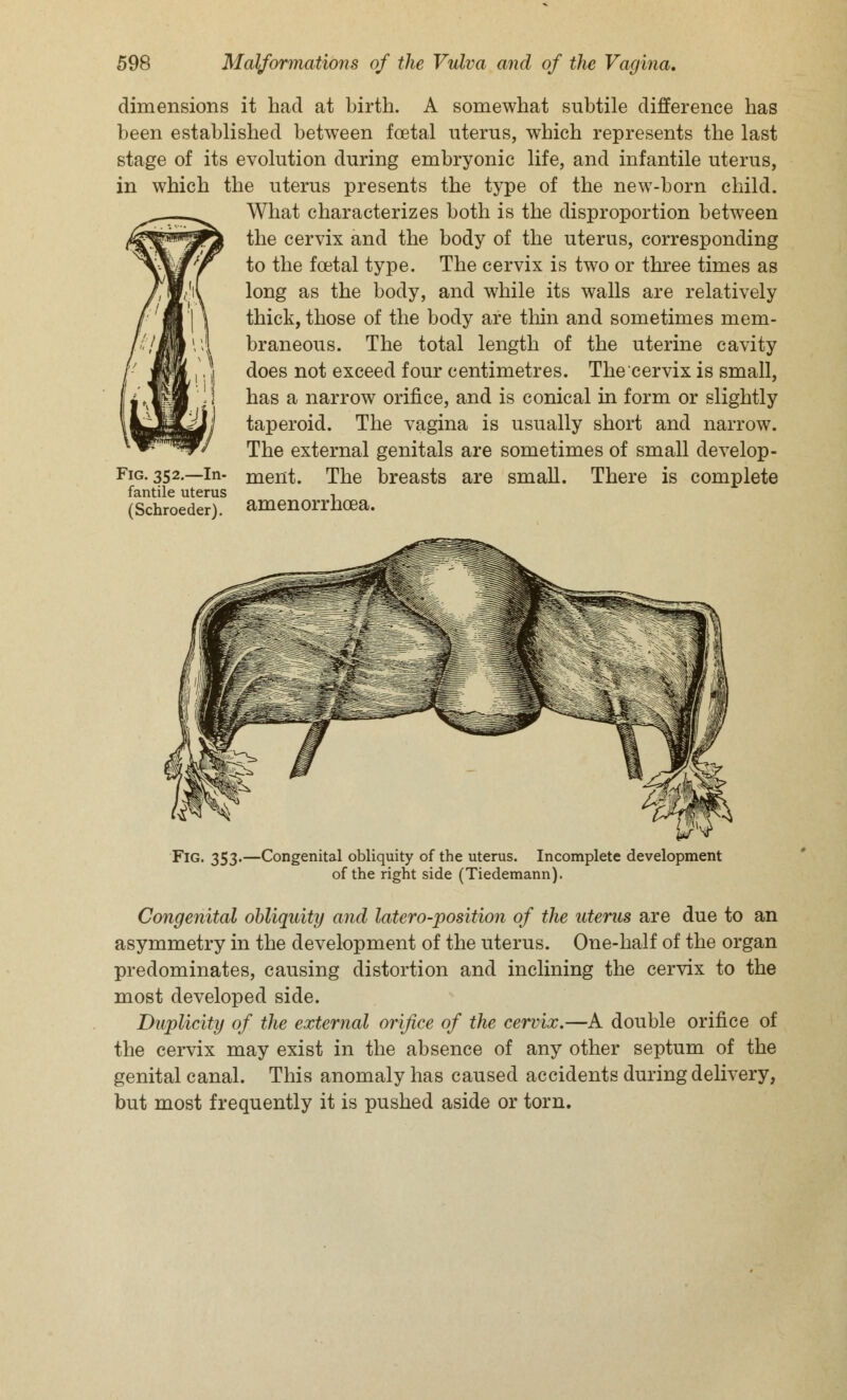 dimensions it had at birth. A somewhat subtile difference has been established between fcetal uterus, which represents the last stage of its evolution during embryonic life, and infantile uterus, in which the uterus presents the type of the new-born child. What characterizes both is the disproportion between the cervix and the body of the uterus, corresponding to the fcetal type. The cervix is two or three times as long as the body, and while its walls are relatively thick, those of the body are thin and sometimes mem- braneous. The total length of the uterine cavity does not exceed four centimetres. The cervix is small, has a narrow orifice, and is conical in form or slightly taperoid. The vagina is usually short and narrow. The external genitals are sometimes of small develop- Fig. 352.—in- ment. The breasts are small. There is complete fantile uterus , (Schroeder). amenorrhoea. Fig. 353.—Congenital obliquity of the uterus. Incomplete development of the right side (Tiedemann). Congenital obliquity and latero-position of the uterus are due to an asymmetry in the development of the uterus. One-half of the organ predominates, causing distortion and inclining the cervix to the most developed side. Duplicity of the external orifice of the cervix.—A double orifice of the cervix may exist in the absence of any other septum of the genital canal. This anomaly has caused accidents during delivery, but most frequently it is pushed aside or torn.