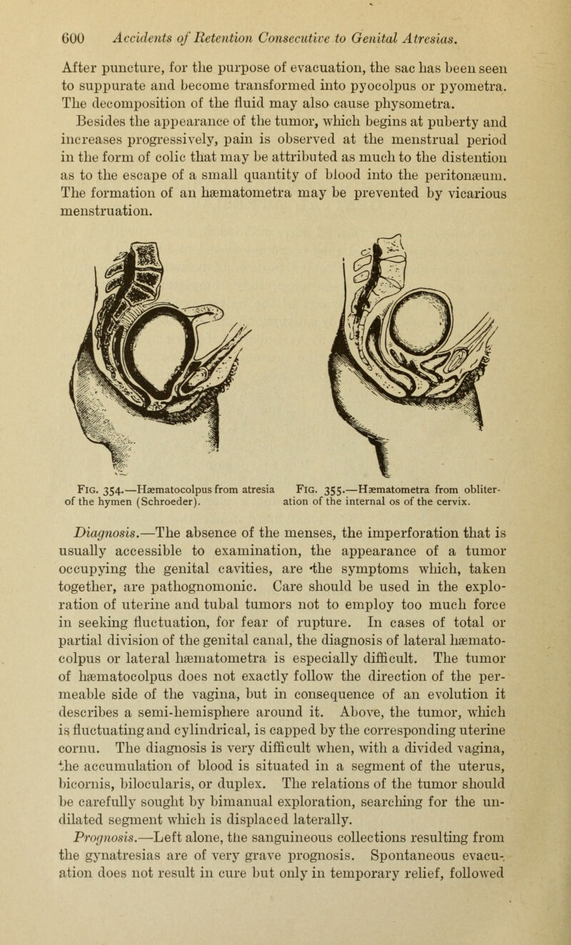 After puncture, for the purpose of evacuation, the sac has been seen to suppurate and become transformed into pyocolpus or pyometra. The decomposition of the fluid may also cause physometra. Besides the appearance of the tumor, which begins at puberty and increases progressively, pain is observed at the menstrual period in the form of colic that may be attributed as much to the distention as to the escape of a small quantity of blood into the peritonaeum. The formation of an hsematometra may be prevented by vicarious menstruation. Fig. 354.—Hsematocolpus from atresia Fig. 355.—Hgematometra from obliter- of the hymen (Schroeder). ation of the internal os of the cervix. Diagnosis.—The absence of the menses, the imperforation that is usually accessible to examination, the appearance of a tumor occupying the genital cavities, are *the symptoms which, taken together, are pathognomonic. Care should be used in the explo- ration of uterine and tubal tumors not to employ too much force in seeking fluctuation, for fear of rupture. In cases of total or partial division of the genital canal, the diagnosis of lateral haamato- colpus or lateral haamatometra is especially difficult. The tumor of hasmatocolpus does not exactly follow the direction of the per- meable side of the vagina, but in consequence of an evolution it describes a semi-hemisphere around it. Above, the tumor, which is fluctuating and cylindrical, is capped by the corresponding uterine cornu. The diagnosis is very difficult when, with a divided vagina, the accumulation of blood is situated in a segment of the uterus, bicornis, bilocularis, or duplex. The relations of the tumor should be carefully sought by bimanual exploration, searching for the un- dilated segment which is displaced laterally. Prognosis.—Left alone, the sanguineous collections resulting from the gynatresias are of very grave prognosis. Spontaneous evacu- ation does not result in cure but only in temporary relief, followed