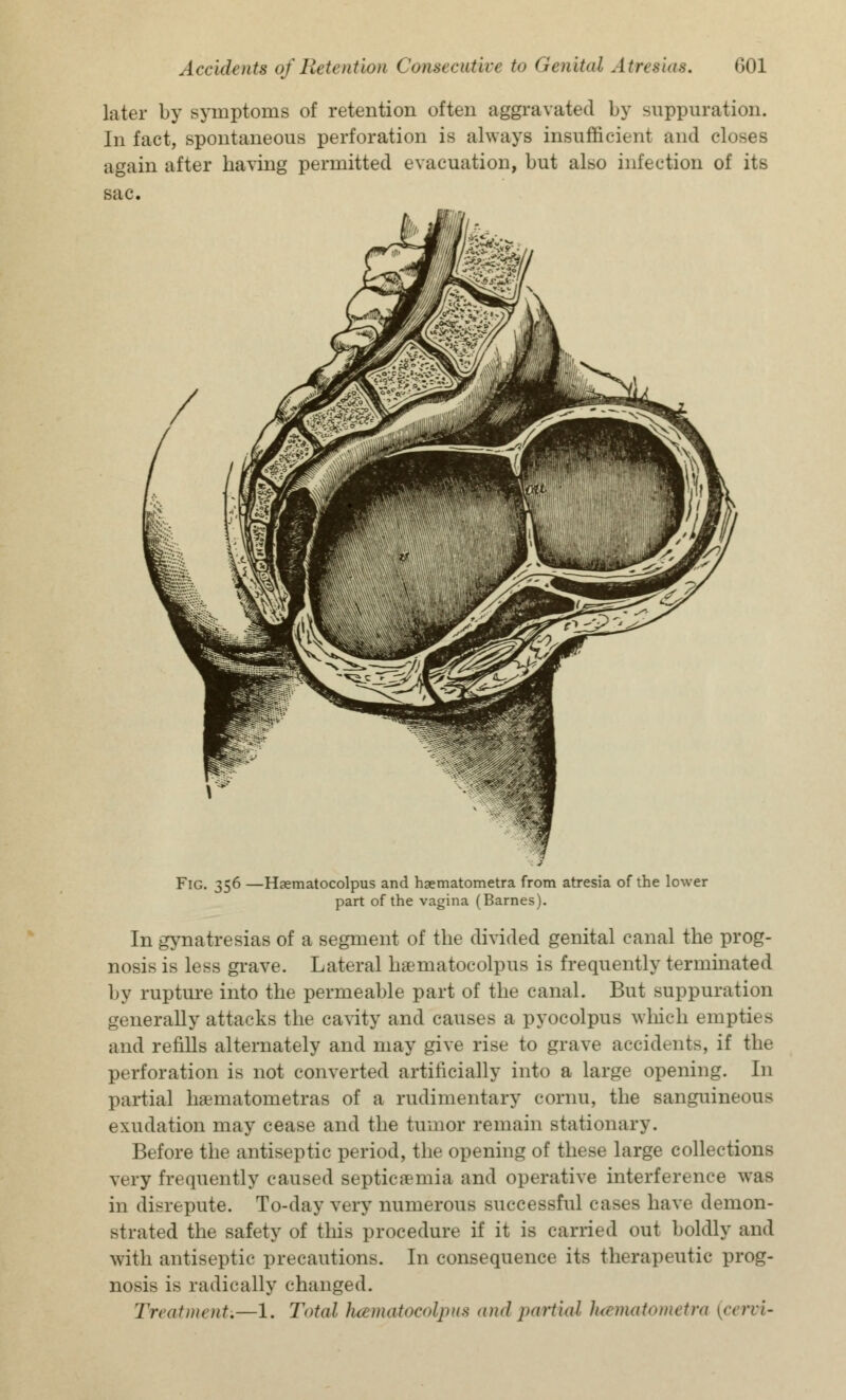 later by symptoms of retention often aggravated by suppuration. In fact, spontaneous perforation is always insufficient and closes again after having permitted evacuation, but also infection of its sac. Fig. 356 —Hsematocolpus and haematometra from atresia of the lower part of the vagina (Barnes). In gynatresias of a segment of the divided genital canal the prog- nosis is less grave. Lateral hsematocolpus is frequently terminated by rupture into the permeable part of the canal. But suppuration generally attacks the cavity and causes a pyocolpus which empties and refills alternately and may give rise to grave accidents, if the perforation is not converted artificially into a large opening. In partial hamatometras of a rudimentary cornu, the sanguineous exudation may cease and the tumor remain stationary. Before the antiseptic period, the opening of these large collections very frequently caused septicaemia and operative interference was in disrepute. To-day very numerous successful cases have demon- strated the safety of this procedure if it is carried out boldly and with antiseptic precautions. In consequence its therapeutic prog- nosis is radically changed. Treatment.—1. Total hamatocolpus and partial hamatometra (cervi-