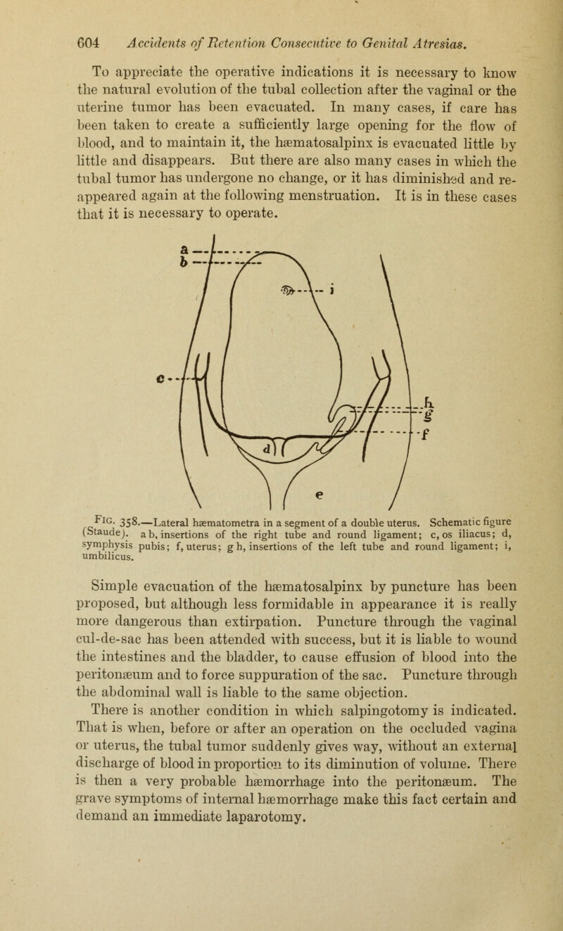 To appreciate the operative indications it is necessary to know the natural evolution of the tubal collection after the vaginal or the uterine tumor has been evacuated. In many cases, if care has been taken to create a sufficiently large opening for the flow of blood, and to maintain it, the hematosalpinx is evacuated little by little and disappears. But there are also many cases in which the tubal tumor has undergone no change, or it has diminished and re- appeared again at the following menstruation. It is in these cases that it is necessary to operate. 0 m«.ir Fig. 358—Lateral hgematometra in a segment of a double uterus. Schematic figure (Staude). ab, insertions of the right tube and round ligament; c, os iliacus; d, symphysis pubis; f, uterus: g h, insertions of the left tube and round ligament; i, umbilicus. Simple evacuation of the haematosalpinx by puncture has been proposed, but although less formidable in appearance it is really more dangerous than extirpation. Puncture through the vaginal cul-de-sac has been attended with success, but it is liable to wound the intestines and the bladder, to cause effusion of blood into the peritonaeum and to force suppuration of the sac. Puncture through the abdominal wall is liable to the same objection. There is another condition in which salpingotomy is indicated. That is when, before or after an operation on the occluded vagina or uterus, the tubal tumor suddenly gives way, without an external discharge of blood in proportion to its diminution of volume. There is then a very probable haemorrhage into the peritonaeum. The grave symptoms of internal haemorrhage make this fact certain and demand an immediate laparotomy.