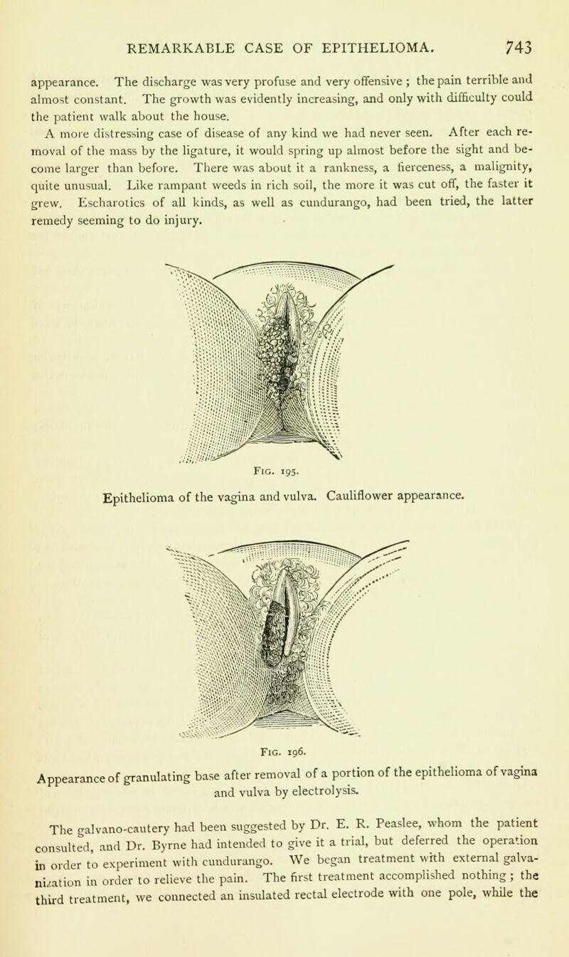 appearance. The discharge was very profuse and very offensive ; the pain terrible and almost constant. The growth was evidently increasing, and only with difficulty could the patient walk about the house. A more distressing case of disease of any kind we had never seen. After each re- moval of the mass by the ligature, it would spring up almost before the sight and be- come larger than before. There was about it a rankness, a fierceness, a malignity, quite unusual. Like rampant weeds in rich soil, the more it was cut off, the faster it grew. Escharotics of all kinds, as well as cundurango, had been tried, the latter remedy seeming to do injury. Fig. 19s. Epithelioma of the vagina and vulva. Cauliflower appearance. Fig. 196. Appearance of granulating base after removal of a portion of the epithelioma of vagina and vulva by electrolysis. The galvano-cautery had been suggested by Dr. E. R. Peaslee, whom the patient consulted, and Dr. Byrne had intended to give it a trial, but deferred the operation in order to experiment with cundurango. We began treatment with external galva- nization in order to relieve the pain. The first treatment accomplished nothing ; the third treatment, we connected an insulated rectal electrode with one pole, while the