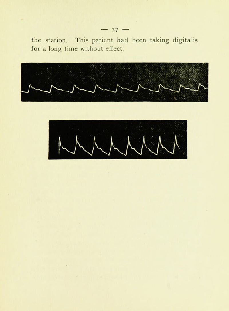 the station. This patient had been taking digitalis for a long time without effect.