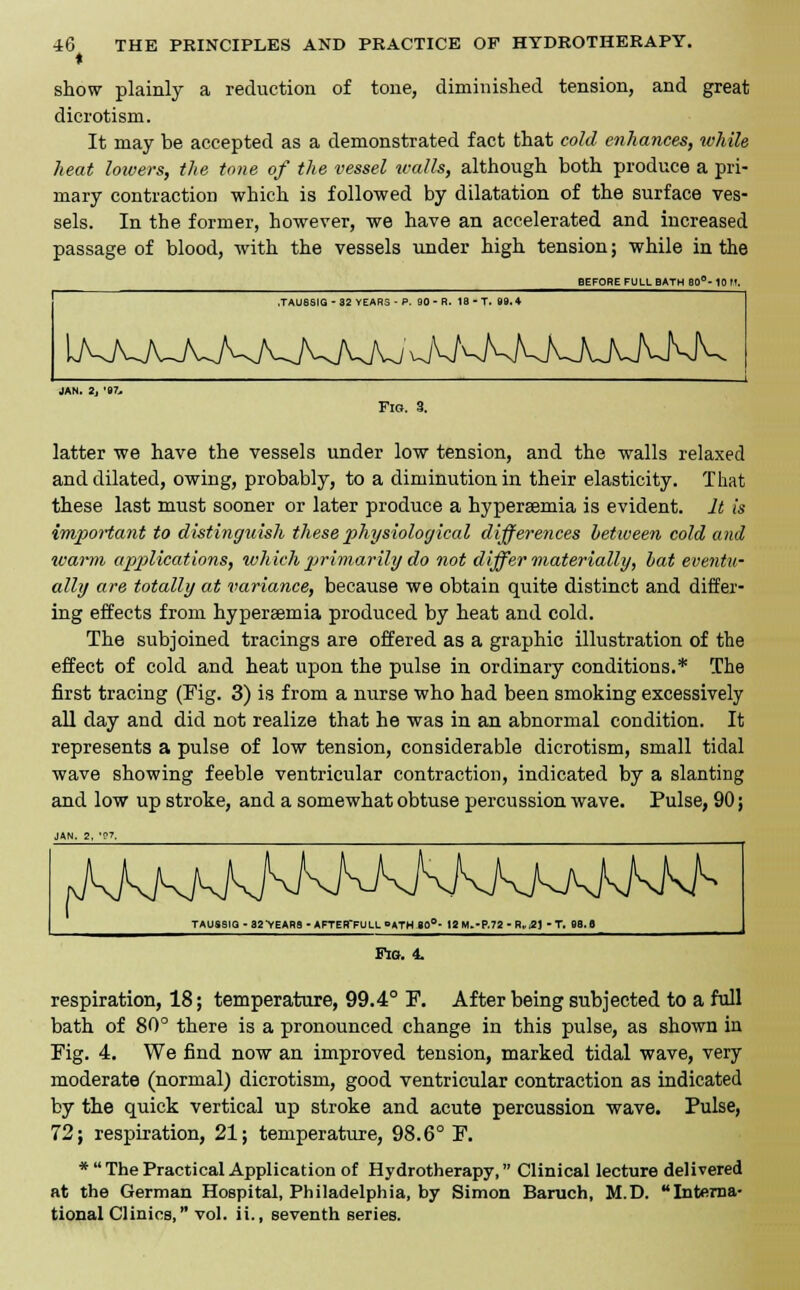 ♦ show plainly a reduction of tone, diminished tension, and great dicrotism. It may be accepted as a demonstrated fact that cold enhances, while heat loivers, the tone of the vessel walls, although both produce a pri- mary contraction which is followed by dilatation of the surface ves- sels. In the former, however, we have an accelerated and increased passage of blood, with the vessels under high tension; while in the BEFORE FULL BATH SO0- 10 Ft. TAUSSIG - 32 YEARS - P. 90 - R. 1S - T. 99. * lAJWU\JV^AJWUJvAAJ^M JAN. 2, '87, Fig. 3. latter we have the vessels under low tension, and the walls relaxed and dilated, owing, probably, to a diminution in their elasticity. That these last must sooner or later produce a hypersemia is evident. It is important to distinguish these physiological differences between cold and warm applications, which primarily do not differ materially, bat eventu- ally are totally at variance, because we obtain quite distinct and differ- ing effects from hyperaemia produced by heat and cold. The subjoined tracings are offered as a graphic illustration of the effect of cold and heat upon the pulse in ordinary conditions.* The first tracing (Fig. 3) is from a nurse who had been smoking excessively all day and did not realize that he was in an abnormal condition. It represents a pulse of low tension, considerable dicrotism, small tidal wave showing feeble ventricular contraction, indicated by a slanting and low up stroke, and a somewhat obtuse percussion wave. Pulse, 90; Fig. 4. respiration, 18; temperature, 99.4° P. After being subjected to a full bath of 80° there is a pronounced change in this pulse, as shown in Pig. 4. We find now an improved tension, marked tidal wave, very moderate (normal) dicrotism, good ventricular contraction as indicated by the quick vertical up stroke and acute percussion wave. Pulse, 72; respiration, 21; temperature, 98.6° P. * The Practical Application of Hydrotherapy, Clinical lecture delivered at the German Hospital, Philadelphia, by Simon Baruch, M.D. Interna- tional Clinics, vol. ii., seventh series.
