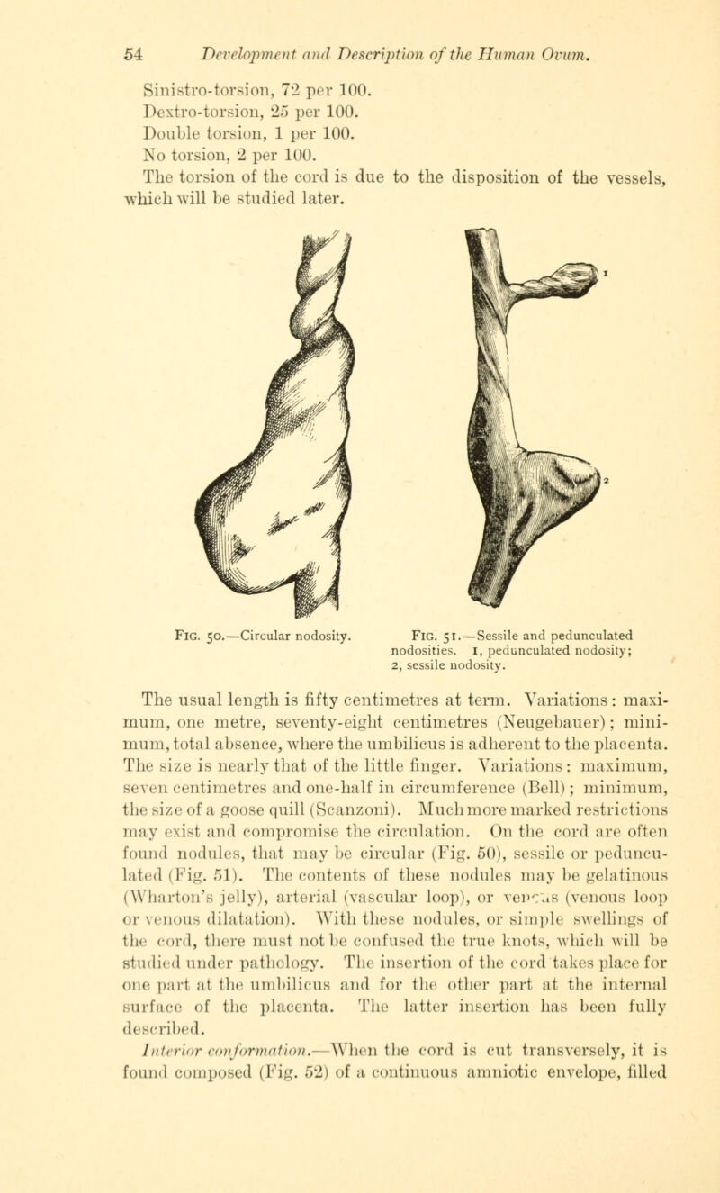 Sinistro-torsion, 72 per 100. Dextro-torsion, 25 per 100. Double torsion, 1 per 100. No torsion, 2 per 100. The torsion of the cord is due to the disposition of the vessels, which will be studied later. Fig. 50.—Circular nodosity. Fig. 51.—Sessile and pedunculated nodosities, i, pedunculated nodosity; 2, sessile nodosity. The usual length is fifty centimetres at term. Variations : maxi- mum, one metre, seventy-eight centimetres (Neugebauer); mini- mum, total absence, where the umbilicus is adherent to the placenta. The size is nearly that of the little finger. Variations : maximum, seven centimetres and one-half in circumference (Bell); minimum, the size of a goose quill (Scanzoni). Muchmore marked restrictions may exist and compromise the circulation. On the cord are often found nodules, that may be circular (Fig. 50), sessile or peduncu- lated (Fig. 51). The contents of these nodules may be gelatinous (Wharton's jelly), arterial (vascular loop), or vePCas (venous loop or venous dilatation). With these nodules, or simple swellings of the COrd, there must not be confused the true Knots, which will be studied under pathology. The insertion of the cord takes place for one pari at the umbilicus and for the other part at the internal Burface of the placenta. The Latter insertion has been fully described. Interior conformation,'- When the cord is cut transversely, it is found composed (Fig. 52) of a continuous amniotic envelope, Idled