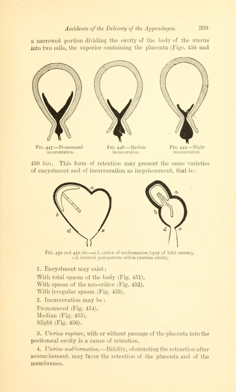 a narrowed portion dividing the cavity of the body of the uterus into two cells, the superior containing the placenta (Figs. 15U and Fig. 447.—Pronounced incarceration. Fig. 448.—Median incarceration. Fig. 449.—Slight incarceration. 450 bis). This form of retention may present the same varieties of encystment and of incarceration as imprisonment, that is: Fig. 450 and 450 bis.—a b, orifice of neoformation (spur of bifid uterus); c d, internal post-partum orifice (uterine circle). 1. Encystment may exist: With total spasm of the body (Fig. 451). With spasm of the neo-oriiice (Fig. 452). With irregular spasm (Fig. 453). •2. Incarceration may be : Pronounced (Fig. 454). Median (Fig. 455). Slight (Fig. 456). 3. Uterine rwptwre, with or without passage of the placenta into the peritoneal cavity is a cause of retention. 4. Uterine malformation.—Bifidity, obstructing the retraction after accouchement, may favor the retention of the placenta and of the membranes.