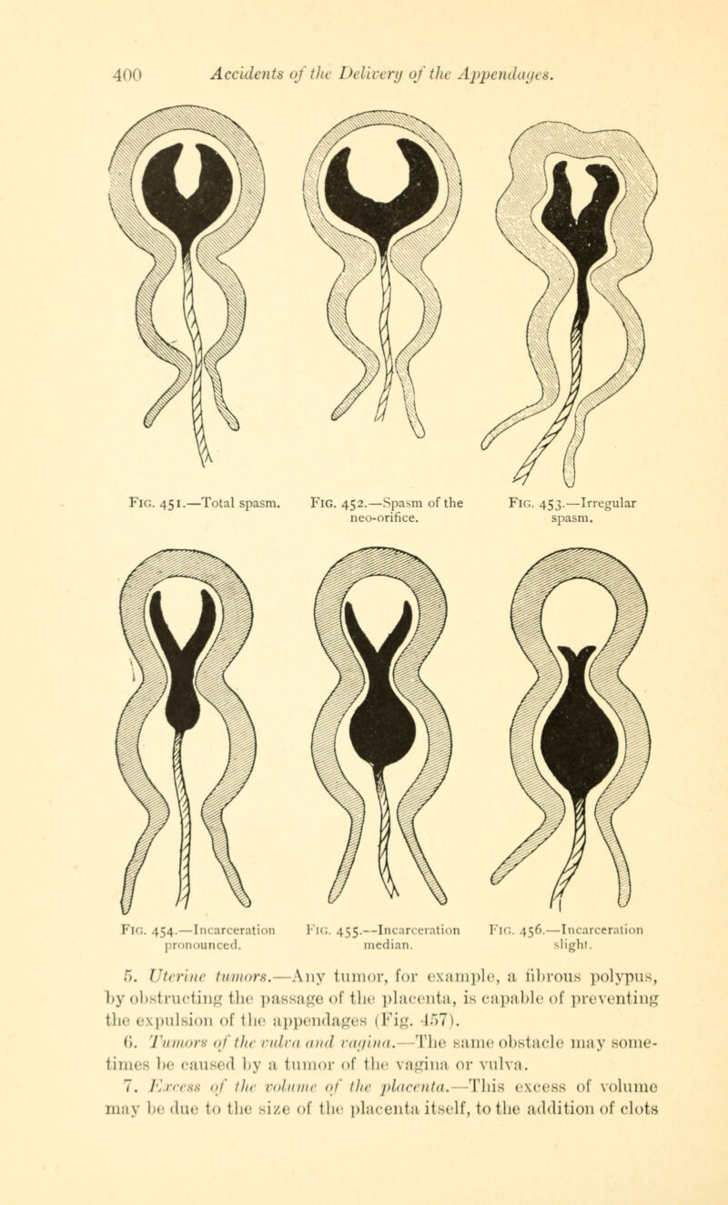 Fig. 451.—Total spasm. Fig. 452.—Spasm of the neo-orifice. Fig. 453.—Irregular spasm. FlG. 454.—Incarceration pronounced. FlG. 455.--Incarceration median. 1 !';. 456.—Incarceration slight. 5. Uterine tumors.— Any tumor, for example, a fibrous polypus, by obstructing the passage of the placenta, is capable of preventing the expulsion of the appendages (Fig. 457). 6. Tumors of the vulva and vagina. The Bame obstacle may some- times be caused by a tumor of the vagina or vulva. 7. Excess of tin volume of the placenta. This excess of volume may be due to the size of the placenta itself, to the addition of clots