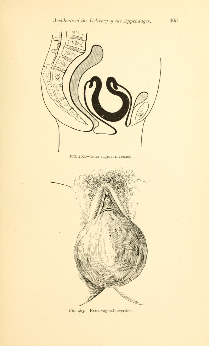 Fig. 462.—Intra-vaginal inversion. FlG. 463.—Extra vaginal inversion.