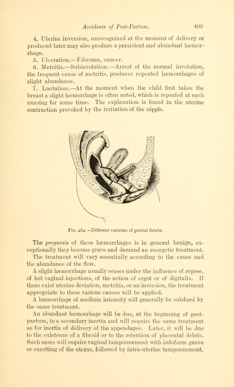 4. Uterine inversion, unrecognized at the moment of delivery or produced later may also produce a persistent and abundant hemor- rhage. 5. Ulceration.—Fibroma, cancer. 6. Metritis.—Subinvolution.—Arrest of the normal involution, the frequent cause of metritis, produces repeated hemorrhages of slight abundance. 7. Lactation.—At the moment when the child first takes the breast a slight haemorrhage is often noted, which is repeated at each nursing for some time. The explanation is found in the uterine contraction provoked by the irritation of the nipple. Fig. 464.—Different varieties of genital fistula?. The prognosis of these haemorrhages is in general benign, ex- ceptionally they become grave and demand an energetic treatment. The treatment will vary essentially according to the cause and the abundance of the now. A slight hemorrhage usually ceases under the influence of repose, of hot vaginal injections, of the action of ergot or of digitalis. If there exist uterine deviation, metritis, or an inversion, the treatment appropriate to these various causes will be applied. A haemorrhage of medium intensity will generally be subdued by the same treatment. An abundant hemorrhage will be due, at the beginning of post- partum, to a secondary inertia and will require the same treatment as for inertia of delivery of the appendages. Later, it will be due to the existence of a fibroid or to the retention of placental debris. Such cases will require vaginal tamponnement with iodoform gauze or curetting of the uterus, followed by intra-uterine tamponnement.