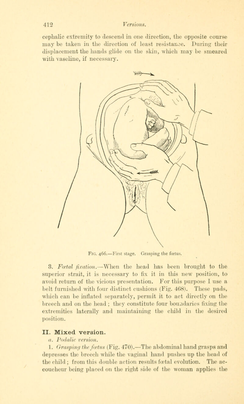 cephalic extremity to descend in one direction, the opposite course may be taken in the direction of least resistance. During their displacement the hands glide on the skin, which may be smeared with vaseline, if necessary. *m—^ Fig. 466.—First stage. Grasping the foetus. 3. Foetal fixation.—When the head has been brought to the superior strait, it is necessary to fix it in this new position, to avoid return of the vicious presentation. For this purpose I use a lull furnished with four distinct cushions (Fig. 1(>8). These pads, which can be inflated separately, permit, it to act directly on the breech and on the head ; they constitute four boundaries fixing the extremities laterally and maintaining the child in the desired position. II. Mixed version. a. PodaMc version. 1. Grasping the foetus \ Fig. 470).—The abdominal hand grasps and depresses the breech while the vaginal hand pushes up the head of the child ; from this double action results foetal evolution. The ;ic- COUcheur being placed on the right side of the woman applies the