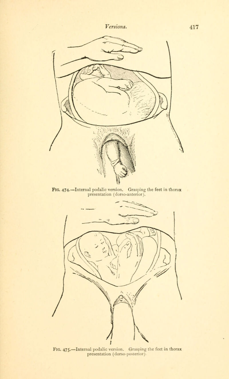 FlG. 474.—Internal podalic version. Grasping the feet in thorax presentation (dorso-anterior). FlG. 475.—Internal podalic version. Grasping the feet in thorax presentation (dorso-posterior).