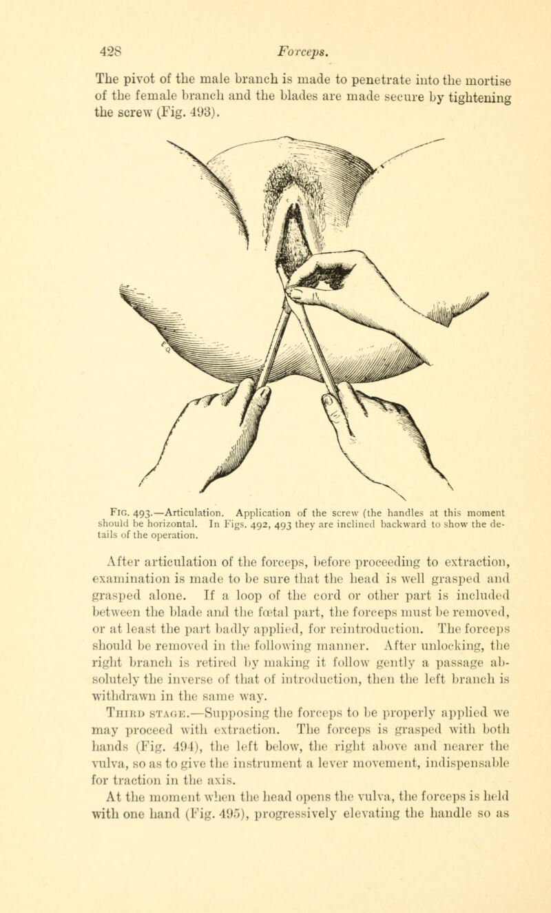 The pivot of the male branch is made to penetrate into the mortise of the female branch and the blades are made secure by tightening the screw (Fig. 4(J3). Fig. 493.—Articulation. Application of the screw (the handles at this moment should be horizontal. In Figs. 492, 493 they are inclined backward to show the de- tails of the operation. After articulation of the forceps, before proceeding to extraction, examination is made to be sure that the head is well grasped and grasped alone. If a loop of the cord or other part is included between the blade ami the foetal part, the forceps must be removed, <))• at least the part badly applied, lor reintroduction. The forceps should be removed in the following manner. After unlocking, the right branch is retired by making it follow gently a passage ab- solutely the inverse of thai of introduction, then the left branch is withdrawn in the same way. Third btage.—Supposing the forceps to he properly applied we may proceed with extraction. The forceps is grasped with both hands (Fig. 494), the left below, the righl above and nearer the VUlva, so as to give the instrument a lever movement, indispensable for traction in the axis. At the moment when the head opens the vulva, tin1 forceps is held with one hand (Fig. 495), progressively elevating the handle so as