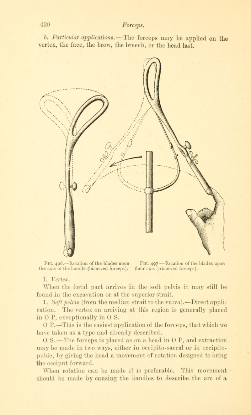 b. Particular applications.-- The forceps may be applied on the vertex, the face, the brow, the breech, or the head last. FlG. 496.—Rotation of the blades upon Fig. 497—Rotation of the blades upon the axis of the handle (bicurved forceps). their s xis (tricurved forceps). I. Vertex. When fche foetal part arrives in the soft pelvis it may still be found in the excavation or at the superior strait. 1. Soft pelvis (from the median strait to the vuiva ).—Direct appli- cation. The vertex on arriving at this region is generally placed in () I', exceptionally in () S. 0 P.—This is the easiest application of the forceps, thai which we have taken as a type and already described. () S. — The forceps is placed as on a head in 0 I\ and extraction may be made in two ways, either in occipito-sacral or in occipito- pubic, by giving the head a movement of rotation designed to bring feh occiput forward. When rotation can he made it is preferable. This movement should he made hy causing the handles to describe the arc of a