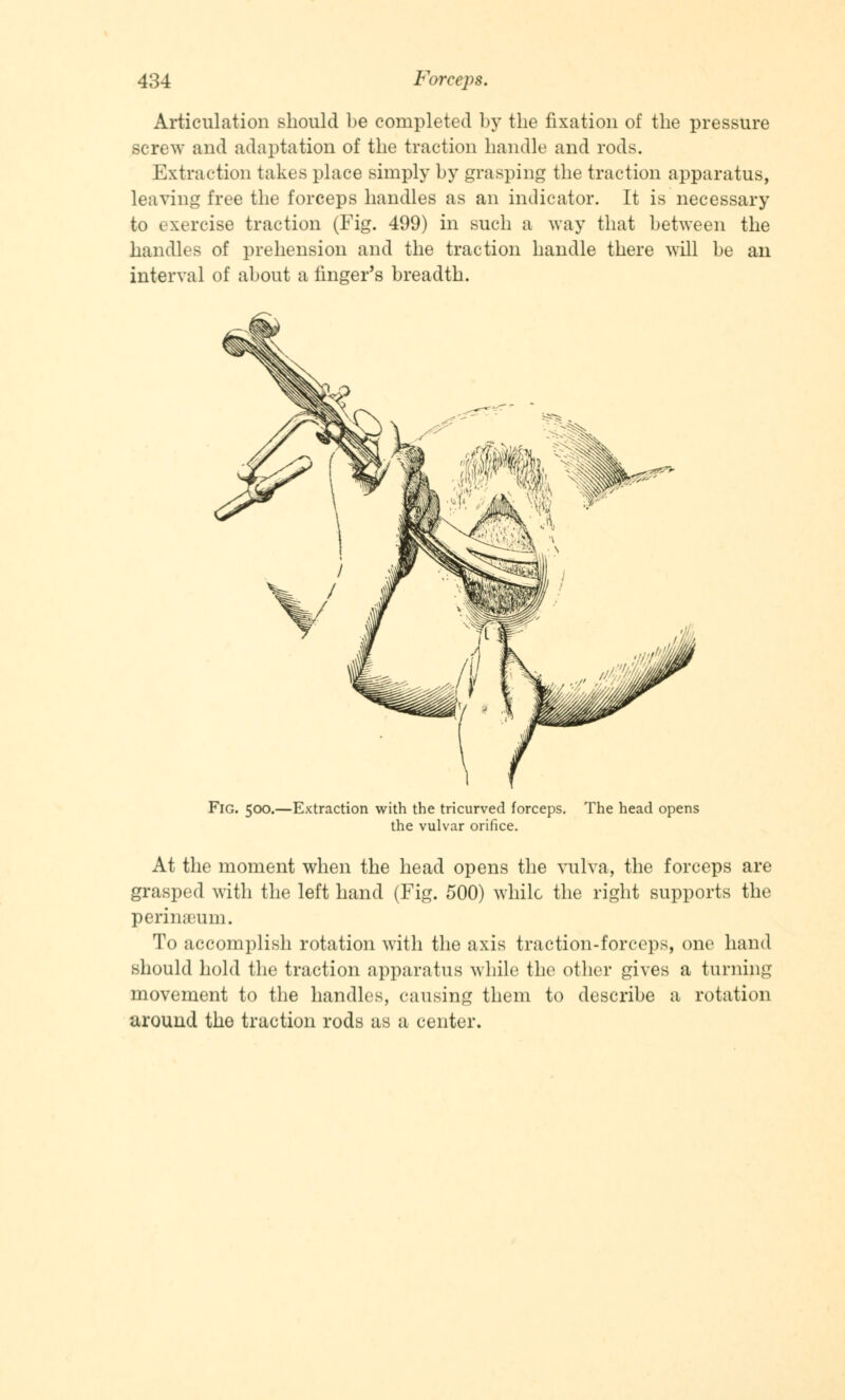 Articulation should be completed by the fixation of the pressure screw and adaptation of the traction handle and rods. Extraction takes place simply by grasping the traction apparatus, leaving free the forceps handles as an indicator. It is necessary to exercise traction (Fig. 499) in such a way that between the handles of prehension and the traction handle there will be an interval of about a finger's breadth. Fig. 500.—Extraction with the tricurved forceps. The head opens the vulvar orifice. At the moment when the head opens the vulva, the forceps are grasped with the left hand (Fig. 500) while the right supports the perinaeum. To accomplish rotation with the axis traction-forceps, one hand should hold the traction apparatus while the other gives a turning movement to the handles, causing them to describe a rotation around the traction rods as a center.