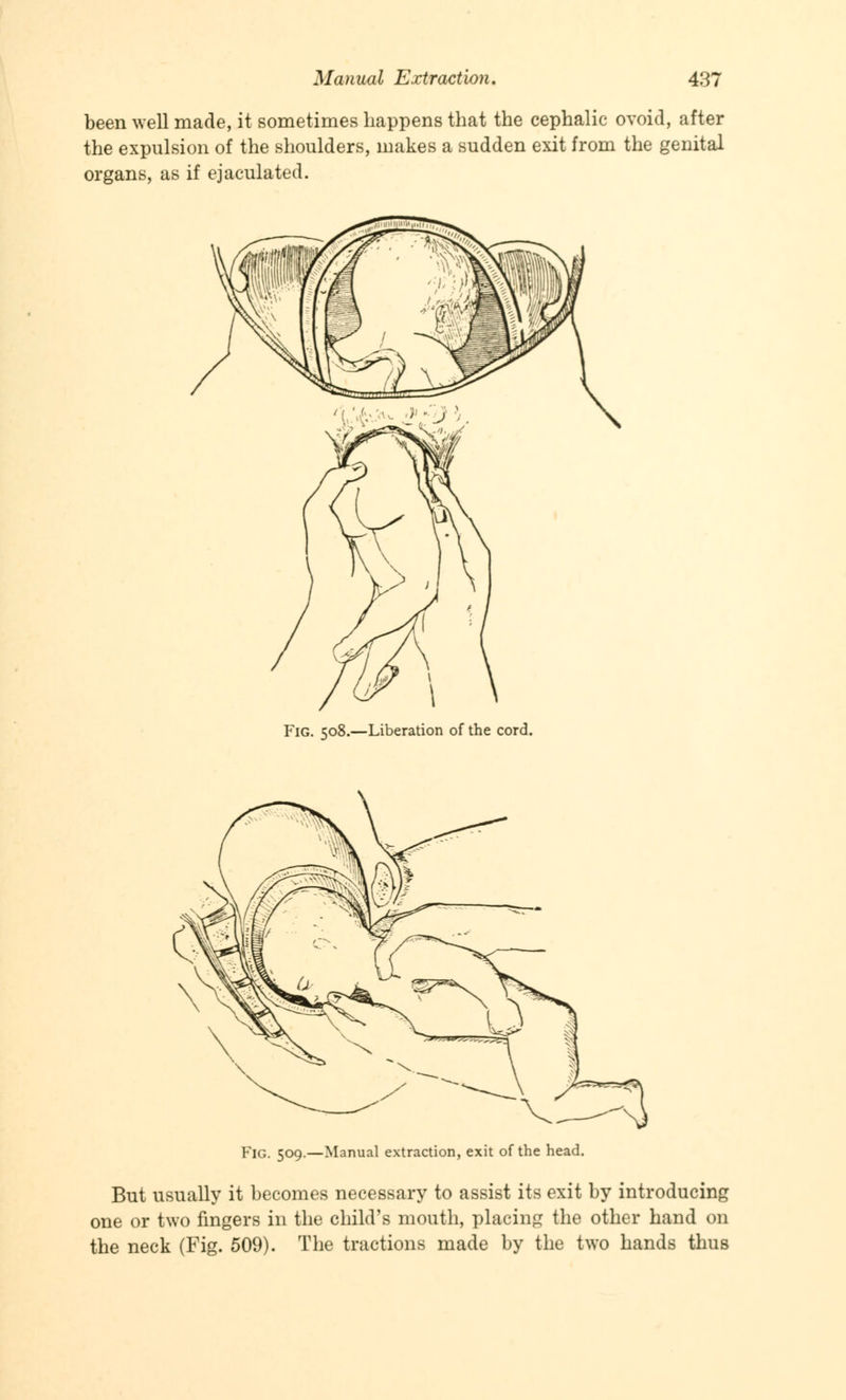 been well made, it sometimes happens that the cephalic ovoid, after the expulsion of the shoulders, makes a sudden exit from the genital organs, as if ejaculated. Fig. 508.—Liberation of the cord. Fig. 509.—Manual extraction, exit of the head. But usually it becomes necessary to assist its exit by introducing one or two fingers in the child's mouth, placing the other hand on the neck (Fig. 509). The tractions made by the two hands thus