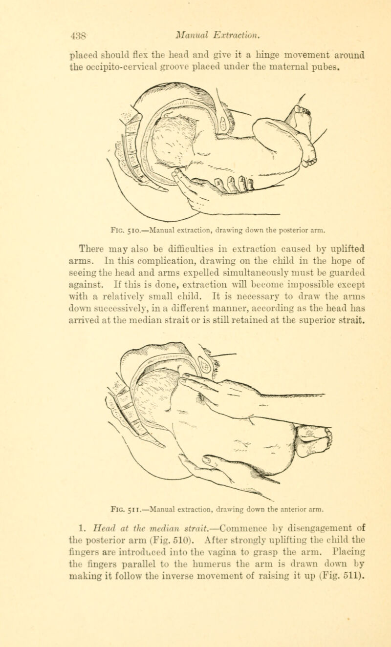 placed should flex the head and give it a hinge movement around the occipitocervical groove placed under the maternal pubes. Fig. 510.—Manual extraction, drawing down the posterior arm. There may also be difficulties in extraction caused by uplifted arms. In this complication, drawing on the child in the hope of seeing the head and arms expelled simultaneously must be guarded against. If this is done, extraction will become impossible except with a relatively small child. It is necessary to draw the arms down successively, in a different manner, according as the head has arrived at the median strait or is still retained at the superior strait. Irawin^ down the anterior arm. 1. Jlcaa1 at the median strait.—Commence by disengagement of the posterior arm I Fi'_r. 510). After strongly 11 pli11i 1 ilt the child the fingers arc introduced into the vagina to grasp the arm. Placing the fingers parallel t<» the humerus the arm i- drawn down by making it follow the inverse movement of raising it up (Fig. oil).