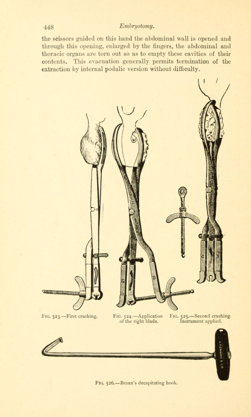 the scissors guided on this hand the abdominal wall is opened and through this opening, enlarged by the lingers, the abdominal and thoracic organs arc torn out so as to empty these cavities of their contents. This evacuation generally permits termination of the extraction by internal podalic version without difficulty. I / FIG. 523.—First crushing. Fig. 524.—Application FlG. 525.—Second crushing, of the right blade. Instrument applied. FlG. 526.—Braun'fl decapitating hook.