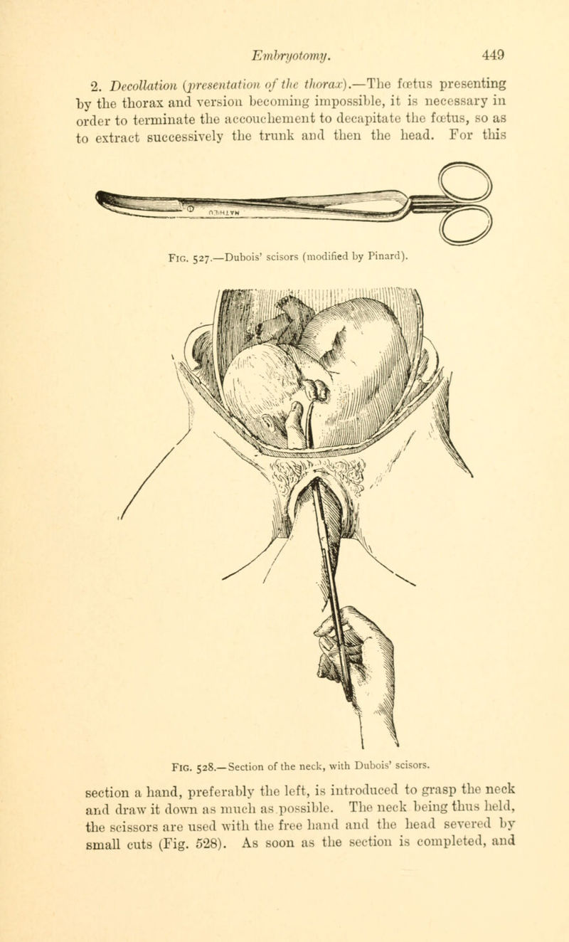 2. Decollation (presentation of the thorax).—-The foetus presenting by the thorax and version becoming impossible, it is necessary in order to terminate the accouchement to decapitate the foetus, so as to extract successively the trunk and then the head. For this Fig. 527.—Dubois' scisors (modified by Pinard). I FlG. 528.—Section of the neck, with Dubois' scisors. section a hand, preferably the left, is introduced to grasp the neck and draw it down as much as possible. The nock being thus held, the scissors are used with the free hand and the head Bevered by small cuts (Fig. 528). As soon as the section is completed, and