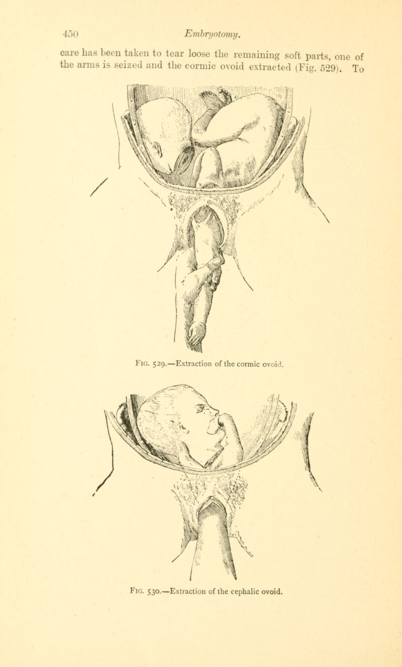 care has hem taken to tear loose the remaining soft parts, one of the arms is seized and the cormic ovoid extracted (Fig. 529). To Fig. 529.—Extraction of the cormic ovoid. FI(;- 53°-—Extraction of the cephalic ovoid.