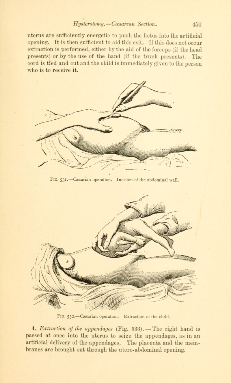 uterus are sufficiently energetic to push the foetus into the artificial opening. It is then sufficient to aid this exit. If this doea not occur extraction is performed, either by the aid of the forceps (if the head presents) or by the use of the hand (if the trunk presents). The cord is tied and cut and the child is immediately given to the person who is to receive it. Fig. 531.—Caesarian operation. Incision of the abdominal wall. Fig. 532.—Caesarian operation. Extraction of the child. 4. Extraction of the appendages (Fig. 533). — The right hand is passed at once into the uterus to seize the appendages, as in ;. artificial delivery of the appendages. The placenta and the mem branes are brought out through the utero-abdominal opening. an