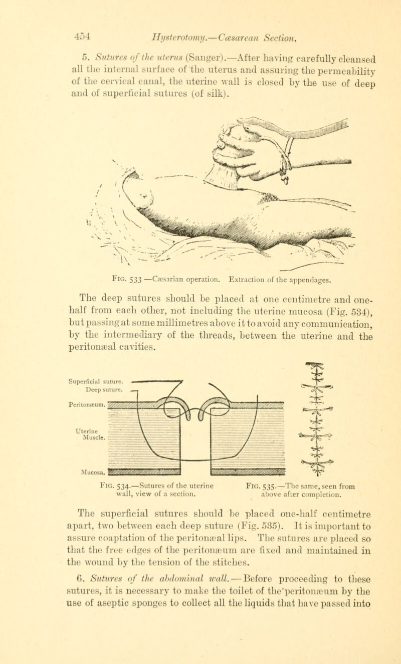 5. Sutures of the uterus (Sanger).—After having carefully cleansed all the interna] surface of'the uterus and assuring the permeability of the cervical canal, the uterine wall is closed by the use of deep and of superficial sutures (of silk). -\ FIG- 533 —Caesarian operation. Extraction of the appendages. The deep sutures should be placed at one centimetre and one- half from each other, not including the uterine mucosa (Fig. 534), but passing at some millimetres above it to avoid any communication, by the intermediary of the threads, between the uterine and the peritonaea! cavities. Superficial suture. Deep suture. —, Peritonaeum *Nc *:$ v IG. 534.—Sutures of the uterine wall, view of a section. FlG. 535-— The same, seen from above after completion. The superficial sutures should be placed one-hall' centimetre apart, two between each dee)) suture I Fig. 585). Ii is important to assure coaptation of the peritonaea) lips. The sutures are placed so that the free edges of the peritonaeum are fixed and maintained in the wound by the tension of the stitches. 6. Sutures of the abdominal wall.—Before proceeding to these sutures, it is necessary to make the toilet of the'peritonseum by the use of aseptic sponges to collect all the liquids that have passed into