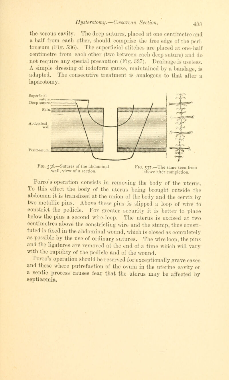 the serous cavity. The deep sutures, placed at one centimetre and a half from each other, should comprise the free edge of the peri- tonaeum (Fig. 536). The superficial Btitches arc placed at one-half centimetre from each other (two between cadi deep suture) and do not require any special precaution (Fig. 537). Drainage is useless. A simple dressing of iodoform gauze, maintained by a bandage, is adapted. The consecutive treatment is analogous to that after a laparotomy. Peritonaeum. Fig. 536.—Sutures of the abdominal wall, view of a section. Fig. 537.—The same seen from above after completion. Porro's operation consists in removing the body of the uterus. To this effect the body of the uterus being brought outside the abdomen it is transfixed at the union of the body and the cervix by two metallic pins. Above these pins is slipped a loop of wire to constrict the pedicle. For greater security it is better to place below the pins a second wire-loop. The uterus is excised at two centimetres above the constricting wire and the stump, thus consti- tuted is fixed in the abdominal wound, which is closed as completely as possible by the use of ordinary sutures. The wire loop, the pins and the ligatures are removed at the end of a time which will vary with the rapidity of the pedicle and of the wound. Porro's operation should be reserved for exceptionally grave cases and those where putrefaction of the ovum in the uterine cavity or a septic process causes fear that the uterus may be affected by septicemia.