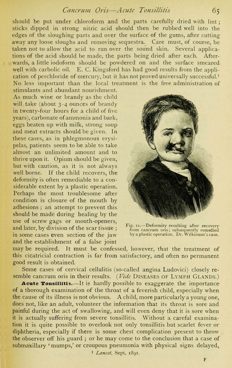 should be put under chloroform and the parts carefully dried with lint ; sticks dipped in strong nitric acid should then be rubbed well into the edges of the sloughing parts and over the surface of the gums, after cutting away any loose sloughs and removing sequestra. Care must, of course, be taken not to allow the acid to run over the sound skin. Several applica- tions of the acid should be made, the parts being dried after each. After- wards, a little iodoform should be powdered on and the surface smeared well with carbolic oil. E. C. Kingsford has had good results from the appli- cation of perchloride of mercury, but it has not proved universally successful.1 No less important than the local treatment is the free administration of stimulants and abundant nourishment. As much wine or brandy as the child will take (about 3-4 ounces of brandy in twenty-four hours for a child of five years), carbonate of ammonia and bark, eggs beaten up with milk, strong soup and meat extracts should be given. In these cases, as in phlegmonous erysi- pelas, patients seem to be able to take almost an unlimited amount and to thrive upon it. Opium should be given, but with caution, as it is not always well borne. If the child recovers, the deformity is often remediable to a con- siderable extent by a plastic operation. Perhaps the most troublesome after condition is closure of the mouth by adhesions ; an attempt to prevent this should be made during healing by the use of screw gags or mouth-openers, and later, by division of the scar tissue ; in some cases even section of the jaw and the establishment of a false joint may be required. It must be confessed, however, that the treatment of this cicatricial contraction is far from satisfactory, and often no permanent good result is obtained. Some cases of cervical cellulitis (so-called angina Ludovici) closely re- semble cancrum oris in their results. {Vide Diseases of Lymph Glands.) Acute Tonsillitis It is hardly possible to exaggerate the importance of a thorough examination of the throat of a feverish child, especially when the cause of its illness is not obvious. A child, more particularly a young one, does not, like an adult, volunteer the information that its throat is sore and painful during the act of swallowing, and will even deny that it is sore when it is actually suffering from severe tonsillitis. Without a careful examina- tion it is quite possible to overlook not only tonsillitis but scarlet fever or diphtheria, especially if there is some chest complication present to throw the observer off his guard ; or he may come to the conclusion that a case of submaxillary ' mumps,' or croupous pneumonia with physical signs delayed, 1 Lancet, Sept. 1891. Fig. 11.—Deformity resulting after recovery from cancrum oris; subsequently remedied by a plastic operation. Dr. Wilkinson's case.