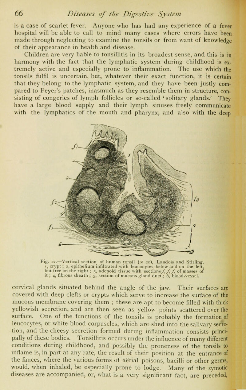 is a case of scarlet fever. Anyone who has had any experience of a fever hospital will be able to call to mind many cases where errors have been made through neglecting to examine the tonsils or from want of knowledge of their appearance in health and disease. Children are very liable to tonsillitis in its broadest sense, and this is in harmony with the fact that the lymphatic system during childhood is ex- tremely active and especially prone to inflammation. The use which the tonsils fulfil is uncertain, but, whatever their exact function, it is certain that they belong to the lymphatic system, and they have been justly com- pared to Peyer's patches, inasmuch as they resemble them in structure, con- sisting of congeries of lymph follicles or so-called ' solitary glands.' They have a large blood supply and their lymph sinuses freely communicate with the lymphatics of the mouth and pharynx, and also with the deep Fig. 12.—Vertical section of human tonsil (x 20), Landois and Stirling. 1, crypt ; 2, epithelium infiltrated with leucocytes belnw and on the lelt, but tree on the right ; 3, adenoid tissue with sections/;/;/, of masses of it ; 4, fibrous sheath ; ;, section of mucous gland duct ; 6, blood-vessel. cervical glands situated behind the angle of the jaw. Their surfaces are covered with deep clefts or crypts which serve to increase the surface of the mucous membrane covering them ; these are apt to become filled with thick yellowish secretion, and are then seen as yellow points scattered over the surface. One of the functions of the tonsils is probably the formation of leucocytes, or white-blood corpuscles, which are shed into the salivary secre- tion, and the cheesy secretion formed during inflammation consists princi- pally of these bodies. Tonsillitis occurs under the influence of many different conditions during childhood, and possibly the proneness of the tonsils to inflame is, in part at any rate, the result of their position at the entrance of the fauces, where the various forms of aerial poisons, bacilli or other germs, would, when inhaled, be especially prone to lodge. Many of the zymotic diseases are accompanied, or, what is a very significant fact, are preceded,