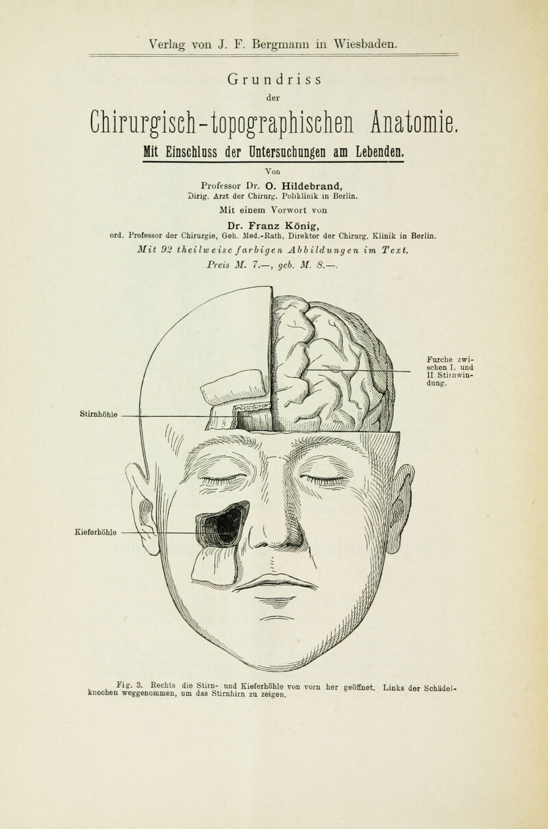 Grundriss der Chirurgisch-topographischen Anatomie, Mit Einschlnss der Untersuchungen am Lebenden. Von Professor Dr. O. Hildebrand, Dirig. Arzt der Chirurg. Poliklinik in Berlin. Mit einem Vorwort von Dr. Franz König, ord. Professor der Chirurgie, Geh. Med.-Eath, Direktor der Chirurg. Klinik in Berlin. Mit 92 theilw eise farbigen Abbildungen im Text. Preis M. 7.—, geb. M. S.—. Stirnhöhle Kieferhöhle V- Furche zwi- schen I. und II Stitnwin- dung. Fig. 3. Rechts die Stirn- und Kieferhöhle von vorn her geöffnet. Links der Schädel- Knochen weggenommen, um das Stirnhirn zu zeigen.