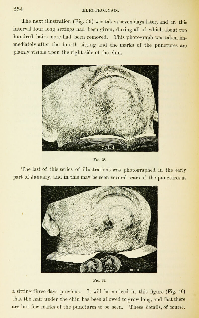 The next illustration (Fig. 39) was taken seven days later, and m this interval four long sittings had been given, during all of which about two hundred hairs more had been removed. This photograph was taken im- mediately after the fourth sitting and the marks of the punctures are plainly visible upon the right side of the chin. Fig. 38. The last of this series of illustrations was photographed in the early part of January, and in this may be seen several scars of the punctures at Fig. 39. a sitting three days previous. It will be noticed in this figure (Fig. 40) that the hair under the chin has been allowed to grow long, and that there are but few marks of the punctures to be seen. These details, of course,