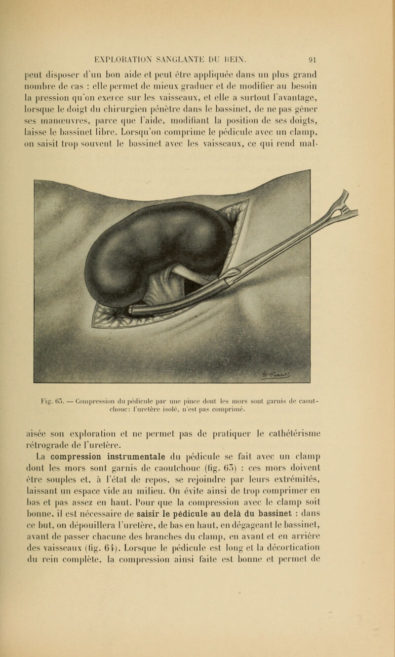 peut disposer d'un bon aide et peul être appliquée dans un plus grand nombre de cas : elle permet de mieux graduer et de modifier au besoin la pression qu'on exerce sur les vaisseaux, et elle a surtout l'avantage, lorsque le doigt du chirurgien pénètre dans le bassinet, de ne pas gêner ses manœuvres, parce que l'aide, modifiant la position de ses doigts, laisse le bassinet libre. Lorsqu'on comprime le pédicule avec un clamp, on saisit trop souvent le bassinet avec les vaisseaux, ce qui rend mal- Fiff. (m. Compression du pédicule par une pince dont les mors sont garnis de caout- chouc: l'uretère isolé, n'est pas comprimé. aisée son exploration et ne permet pas de pratiquer le cathétérisme rétrograde de l'uretère. La compression instrumentale du pédicule se fait avec un clamp dont les mors sont garnis de caoutchouc (fig. 65) : ces mors doivent être souples et, à l'état de repos, se rejoindre par leurs extrémités, laissant un espace vide au milieu. On évite ainsi de trop comprimer en bas et pas assez en haut. Pour que la compression avec le clamp soit bonne, il est nécessaire de saisir le pédicule au delà du bassinet : dans ce but, on dépouillera l'uretère, de bas en haut, en dégageant le bassinet, avant de passer chacune des branches du clamp, en avant et en arrière des vaisseaux (fig. 61). Lorsque le pédicule est long et la décortication du rein complète, la compression ainsi faite est bonne et permet de