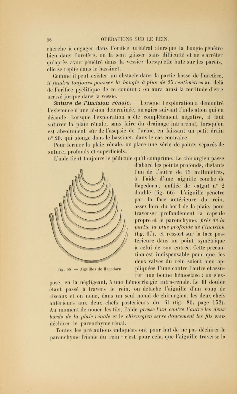 cherche à engager dans l'orifice urétéral : lorsque la bougie pénètre bien dans l'uretère, on la sent glisser sans difficulté et ne s'arrêter qu'après avoir pénétré dans la vessie; lorsqu'elle bute sur les parois, elle se replie dans le bassinet. Comme il peut exister un obstacle dans la partie basse de l'uretère, il faudra toujours pousser la bougie à plus de 25 centimètres au delà de l'orifice pyélitique de ce conduit : on aura ainsi la certitude d'être arrivé jusque dans la vessie. Suture de l'incision rénale. — Lorsque l'exploration a démontré l'existence d'une lésion déterminée, on agira suivant l'indication qui en découle. Lorsque l'exploration a été complètement négative, il faut suturer la plaie rénale, sans faire du drainage intrarénal, lorsqu'on est absolument sûr de l'asepsie de l'urine, en laissant un petit drain n° 20, qui plonge dans le bassinet, dans le cas contraire. Pour fermer la plaie rénale, on place une série de points séparés de suture, profonds et superficiels. L'aide tient toujours le pédicule qu'il comprime. Le chirurgien passe d'abord les points profonds, distants l'un de l'autre de 15 millimètres, à l'aide d'une aiguille courbe de llagedorn, enfilée de catgut n° 2 doublé (fig. 66). L'aiguille pénètre par la face antérieure du rein, assez loin du bord de la plaie, pour traverser profondément la capsule propre et le parenchyme, près de la partie la plus profonde de Vincision (tig. 67), et ressort sur la face pos- térieure dans un point symétrique à celui de son entrée. Cette précau- tion est indispensable pour que les deux valves du rein soient bien ap- pliquées l'une contre l'autre et assu- rer une bonne hémostase : on s'ex- on la négligeant, à une hémorrhagie intra-rénale. Le til double passé à travers le rein, on détache l'aiguille d'un coup <lc ciseaux cl ou noue, dans un seul nœud de chirurgien, les deux chefs antérieurs aux deux chefs postérieurs du lil (lig. 80, page 152). Au moment de nouer les (ils, l'aide presse l un contre Vautre les deux (tords de ta plaie rénale et le chirurgien serre doucement les /ils sans déchirer le parenchyme rénal. Toutes les précautions indiquées oui pour but de ne pas déchirer le parenchyme friable du rein : c'est pour cela, que l'aiguille traverse la Aiguilles de llagedorn pose, étant