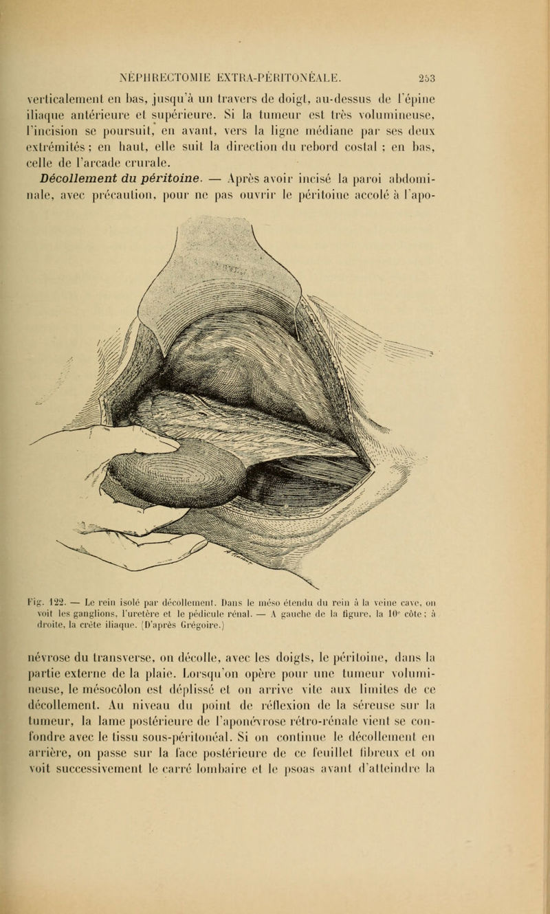 verticalement en bas, jusqu'à un travers de doigt, au-dessus de l'épine iliaque antérieure et supérieure. Si la tumeur est très volumineuse, l'incision se poursuit, en avant, vers la ligne médiane par ses deux extrémités ; en haut, elle suit la direction du rebord costal ; en bas, celle de l'arcade crurale. Décollement du péritoine. — Après avoir incisé la paroi abdomi- nale, avec précaution, pour ne pas ouvrir le péritoine accolé à l'apo- Fig. 122. — Le rein isolé par décollement. Dans le inéso étendu du rein à la veine cave, un voit les ganglions, l'uretère et le pédicule rénal. — A gauche de la figure, la 10e côte; à droite, la crête iliaque. (D'après Grégoire.) névrose du transverse, on décolle, avec les doigts, le péritoine, dans la partie externe de la plaie. Lorsqu'on opère pour une tumeur volumi- neuse, le mésocôlon est déplissé et on arrive vite aux limites de ce décollement. Au niveau du point de réflexion de la séreuse sur la tumeur, la lame postérieure de l'aponévrose rétro-rénale vient se con- fondre avec le tissu sous-périlonéal. Si on continue le décollement en arrière, on passe sur la face postérieure de ce feuillet fibreux et on voit successivement le carré lombaire et le psoas avant d'atteindre la