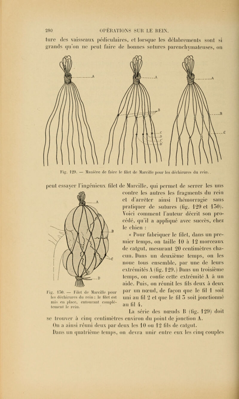 ture des vaisseaux pédiculaires, et lorsque les délabrements sont si grands qu'on ne peut faire de bonnes sutures parenchymateuses, on Fig- 129. — Manière de faire le filet de Marcille pour les déchirures du rein. peut essayer l'ingénieux filet de Marcille, qui permet de serrer les uns contre les antres les fragments du rein et d'arrêter ainsi l'hémorragie sans pratiquer de sutures (fig. 129 et 150). Voici comment Tau leur décrit son pro- cédé, qu'il a appliqué avec succès, chez le chien : « Pour fabriquer le filet, dans un pre- mier temps, on taille 10 à 12 morceaux de catgut, mesurant 20 centimètres cha- cun. Dans un deuxième temps, on les noue tous ensemble, par une de leurs extrémités A (fig. 129.) Dans un troisième temps, on confie cette extrémité À à un aide. Puis, on réunit les lils deux à deux |>;ir un nœud, de façon que le lil 1 soi 1 uni au (il 2 el que le lil 3 soit jonctionné au lil 4. La série des nœuds \\ (fig. 129) doit se trouver à cinq centimètres environ du point de jonction A. On ;i ainsi réuni deux par deux les 10 ou 12 (ils de cal gui. Dans un quatrième temps, on devra unir entre eux les cinq couples Fig. 130. — Filel de Marcille pour les déchirures du rein : le filet est. mis en place, entourant complè- tement le rein.