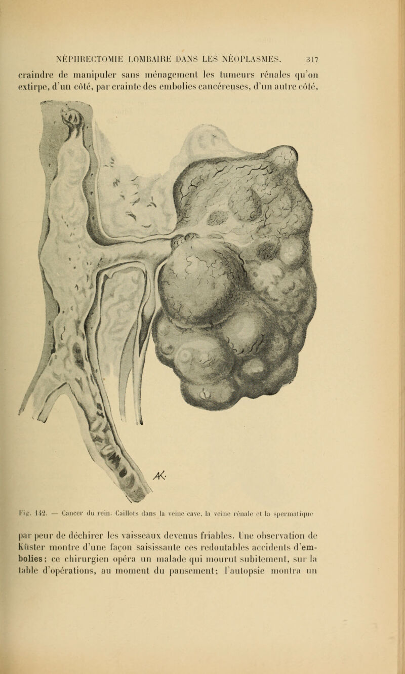 craindre de manipuler sans ménagement les tumeurs rénales qu'on extirpe, d'un côté, par crainte des embolies cancéreuses, d'un autre côté, é\ >*<• IV- 142. — Cancer du rein. Caillots dans la veine cave, la veine rénale el la spermatiquc par peur de déchirer les vaisseaux devenus friables. Une observation de Kûster montre d'une façon saisissante ces redoutables accidents d'em- bolies; ce chirurgien opéra un malade qui mourut subitement, sur la table d'opérations, au moment (\u pansement; l'autopsie montra un