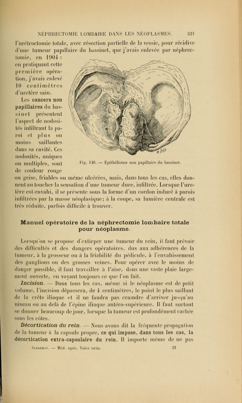 l'urétroctomie totale, avec résection partielle de la vessie, pour récidive d'une tumeur papillaire du bassinet, que j'avais enlevée par néphrec- tomie, en 1904 : en pratiquant cette pie in i ère opéra- tion, j'avais enlevé 10 centimètres d'uretère sain. Les cancers non papillaires du bas- si net présentent l'aspect de nodosi- tés infiltrant la pa- roi et plus ou moins saillantes dans sa cavité. Ces nodosités, uniques OU multiples sont ^*°' ^* — Épithélioma non papillaire du bassinet. de couleur rouge ou grise, friables ou même ulcérées, mais, dans tous les cas, elles don- nent au toucher la sensation d'une tumeur dure, infiltrée. Lorsque l'ure- tère est envahi, il se présente sous la forme d'un cordon induré à parois infiltrées par la masse néoplasique; à la coupe, sa lumière centrale est très réduite, parfois difficile à trouver. Manuel opératoire de la néphrectomie lombaire totale pour néoplasme. Lorsqu'on se propose d'extirper une tumeur du rein, il faut prévoir des difficultés et des dangers opératoires, dus aux adhérences de la tumeur, à la grosseur ou à la friabilité du pédicule, à l'envahissement des ganglions ou des grosses veines. Pour opérer avec le moins de danger possible, il faut travailler à l'aise, dans une vaste plaie large- ment ouverte, en voyant toujours ce que l'on fait. Incision. — Dans tous les cas, même si le néoplasme est de petit volume, l'incision dépassera, de 4 centimètres, le point le plus saillant de la crête iliaque et il ne faudra pas craindre d'arriver jusqu'au niveau ou au delà de l'épine iliaque antéro-supérieure. Il faut surtout se donner beaucoup de jour, lorsque la tumeur est profondément cachée sous les cotes. Décortication du rein. — Nous avons dit la fréquente propagation de la tumeur à la capsule propre, ce qui impose, dans tous les cas, la décortication extra-capsulaire du rein. Il importe même de ne pas Albaiiran. — Méd. opér. Voies urin. 21