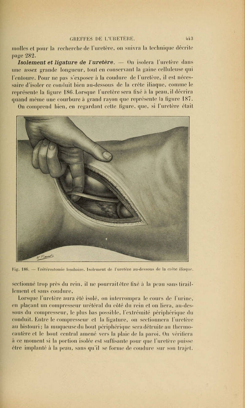 molles et pour la recherche de l'uretère, on suivra la technique décrite page 282. Isolement et ligature de l'uretère. — On isolera l'uretère dans une assez grande longueur, tout en conservant la gaine celluleuse qui l'entoure. Pour ne pas s'exposer à la coudure de l'uretère, il est néces- saire d'isoler ce conduit bien au-dessous de la crête iliaque, comme le représente la figure 186. Lorsque l'uretère sera fixé à la peau.il décrira quand même une courbure à grand rayon que représente la figure 187. On comprend bien, en regardant cette figure, que, si l'uretère était Kig. 186. — Urétérostomie lombaire. Isolement de l'uretère au-dessous de la crèle iliaque. sectionné trop près du rein, il ne pourrait être fixé à la peau sans tirail- lement et sans coudure, Lorsque l'uretère aura été isolé, on interrompra le cours de l'urine, en plaçant un compresseur urétéral du côté du rein et on liera, au-des- sous du compresseur, le plus bas possible, l'extrémité périphérique du conduit. Entre le compresseur et la ligature, on sectionnera l'uretère au bistouri; la muqueuse du bout périphérique sera détruite au thermo- cautère et le bout central amené vers la plaie de la paroi. On vérifiera à ce moment si la portion isolée est suffisante pour que l'uretère puisse être implanté à la peau, sans qu'il se forme de coudure sur son trajet.