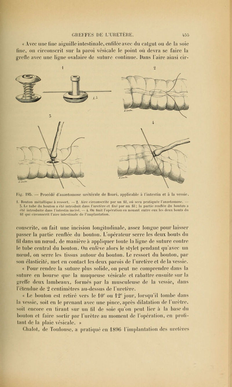 « Avec une fine aiguille intestinale, enfilée avec du catgut ou de la soie fine, on circonscrit sur la paroi vésicale le point où devra se faire la grefïe avec une ligne ovalaire de suture continue. Dans Taire ainsi cir- 1 2 195. Procédé d'anastomose urétérale de Boari, applicable à l'intestin et à la vessie. 1. Bouton métallique à ressort. — 2. Aire circonscrite par un fil, où sera pratiquée l'anastomose. — 5. Le tube du bouton a été introduit dans l'uretère et fixé par un fil; la partie renflée du bouton a été introduite dans l'intestin incisé. — 4. On finit l'opération en nouant entre eux les deux bouts dn fil qui circonscrit l'aire intestinale de l'implantation. consente, on fait une incision longitudinale, assez longue pour laisser passer la partie renflée du bouton. L'opérateur serre les deux bouts du fil dans un nœud, de manière à appliquer toute la ligne de suture contre le tube central du bouton. On enlève alors le stylet pendant qu'avec un nœud, on serre les tissus autour du bouton. Le ressort du bouton, par son élasticité, met en contact les deux parois de l'uretère et de la vessie. « Pour rendre la suture plus solide, on peut ne comprendre dans la suture en bourse que la muqueuse vésicale et rabattre ensuite sur la grefïe deux lambeaux, formés par la musculeuse de la vessie, dans l'étendue de 2 centimètres au-dessus de l'uretère. « Le bouton est retiré vers le 10e ou 12e jour, lorsqu'il tombe dans la vessie, soit en le prenant avec une pince, après dilatation de l'urètre, soit encore en tirant sur un fil de soie qu'on peut lier à la base du bouton et faire sortir par l'urètre au moment de l'opération, en profi- tant de la plaie vésicale. » Chalot, de Toulouse, a pratiqué en 1896 l'implantation des uretères