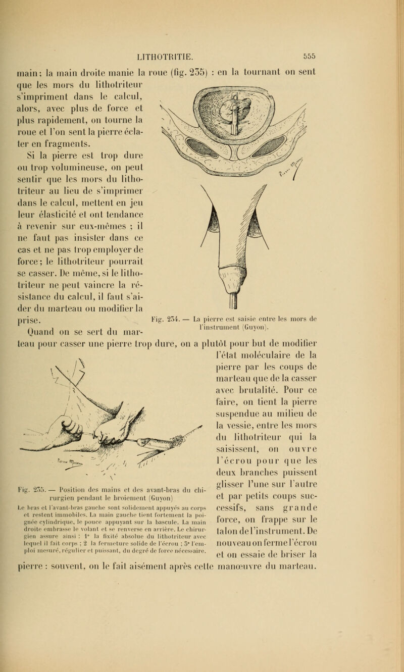 main; la main droite manie la roue (fig. 235) : en que les mors du lithotriteur s'impriment dans le calcul, alors, avec plus de force et plus rapidement, on tourne la roue et l'on sent la pierre écla- ter en fragments. Si la pierre est trop dure ou trop volumineuse, on peut sentir que les mors du litho- triteur au lieu de s'imprimer dans le calcul, mettent en jeu leur élasticité et ont tendance à revenir sur eux-mêmes ; il ne faut pas insister dans ce cas et ne pas trop employer de force; le lithotriteur pourrait se casser. De même, si le litho- triteur ne peut vaincre la ré- sistance du calcul, il faut s'ai- der du marteau ou modifier la ia tournant on sent Fil 254. — La pierre est saisie entre les mors de l'instrument (Guyon). prise. Quand on se sert du mar teau pour casser une pierre trop dure, on a plutôt pour but de modifier l'état moléculaire de la pierre par les coups de marteau que de la casser avec brutalité. Pour ce faire, on tient la pierre suspendue au milieu de la vessie, entre les mors du lithotriteur qui la saisissent, on ouvre l'écrou pour que les deux branches puissent glisser l'une sur l'autre et par petits coups suc- cessifs, sans grande force, on frappe sur le talon del'instrument. De nouveau on ferme l'écrou et on essaie de briser la e fait aisément après celle manœuvre du marteau. Fig. 235. — Position des mains et des avant-bras du chi- rurgien pendant le broiement (Guyon) Le bras et l'avant-bras gauche sont solidement appuyés au corps et îcstent immobiles. La main gauche tient fortement la poi- gnée cylindrique, le pouce appuyant sur la bascule. La main droite embrasse le volant et se renverse en arrière. Le chirur- gien assure ainsi : 1° la fixité absolue du lithotriteur avec lequel il t'ait corps ; 2 la fermeture solide de l'écrou ; 5° l'em- ploi mesuré, régulier et puissant, du degré de force nécessaire. pierre : souvent, on